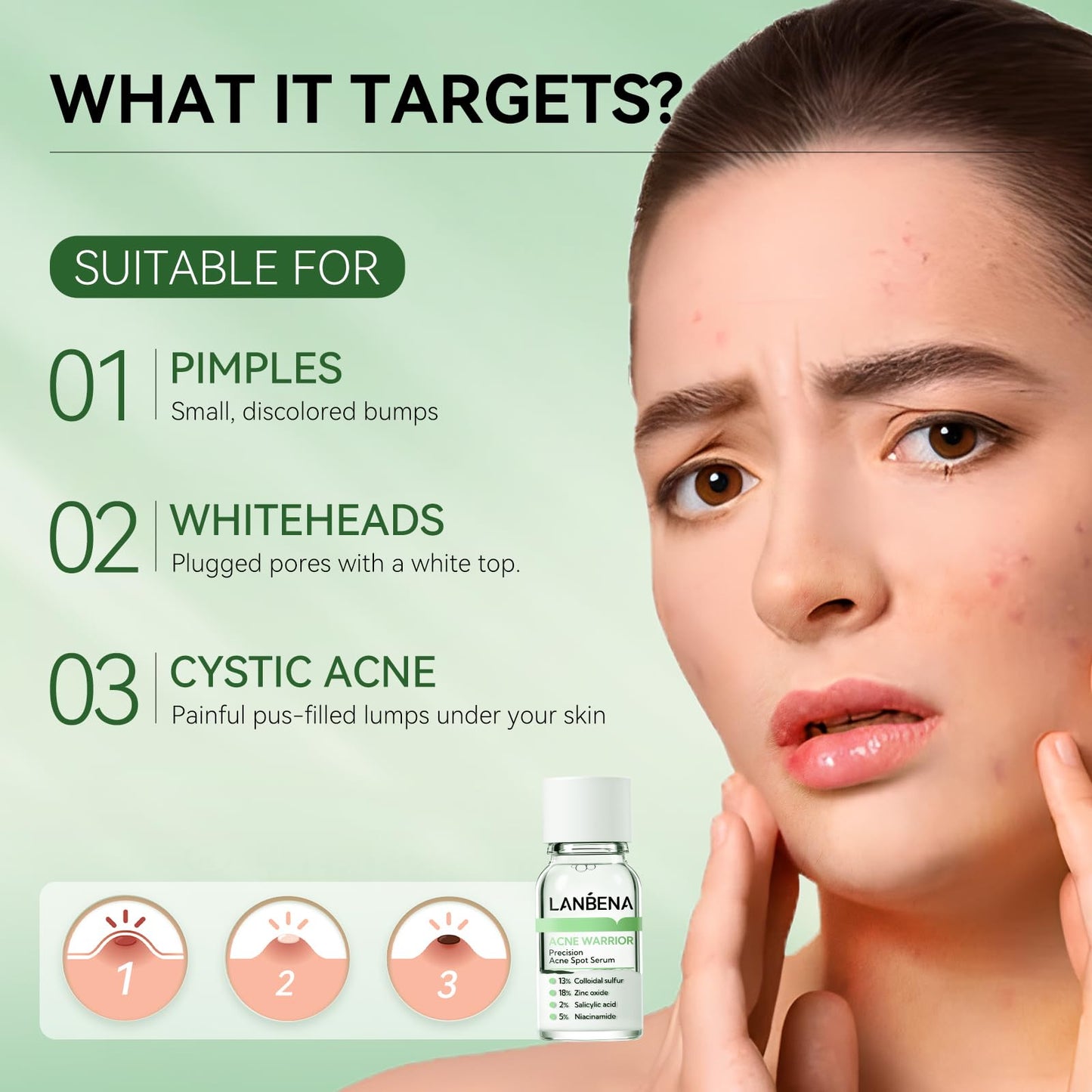 LANBENA Precision Acne Spot Serum, Acne Drying Lotion, Overnight Acne Treatment For Face, Dry Out Pimples, Blemishes, Zits And Clean Pores, 0.43 Fl Oz