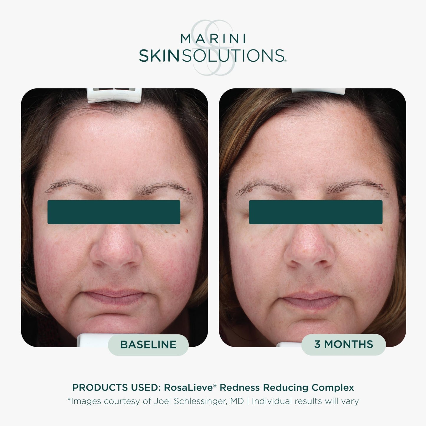 Marini SkinSolutions RosaLieve - Redness Reducing Face Lotion with Azelaic Acid & Tetrapeptide-14 - Cruelty Free - Made in the USA - 1 fl oz