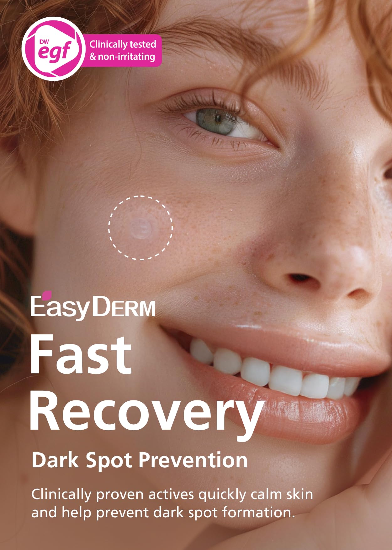 Easyderm Real Calming Patch Microdart Pimple Patches, Clear Nano Micropoint | Niacinamide, Hyaluronic Acid, EGF Acne Dark Spot Care, K-beauty | 12 Counts Summer & Travel Essentials