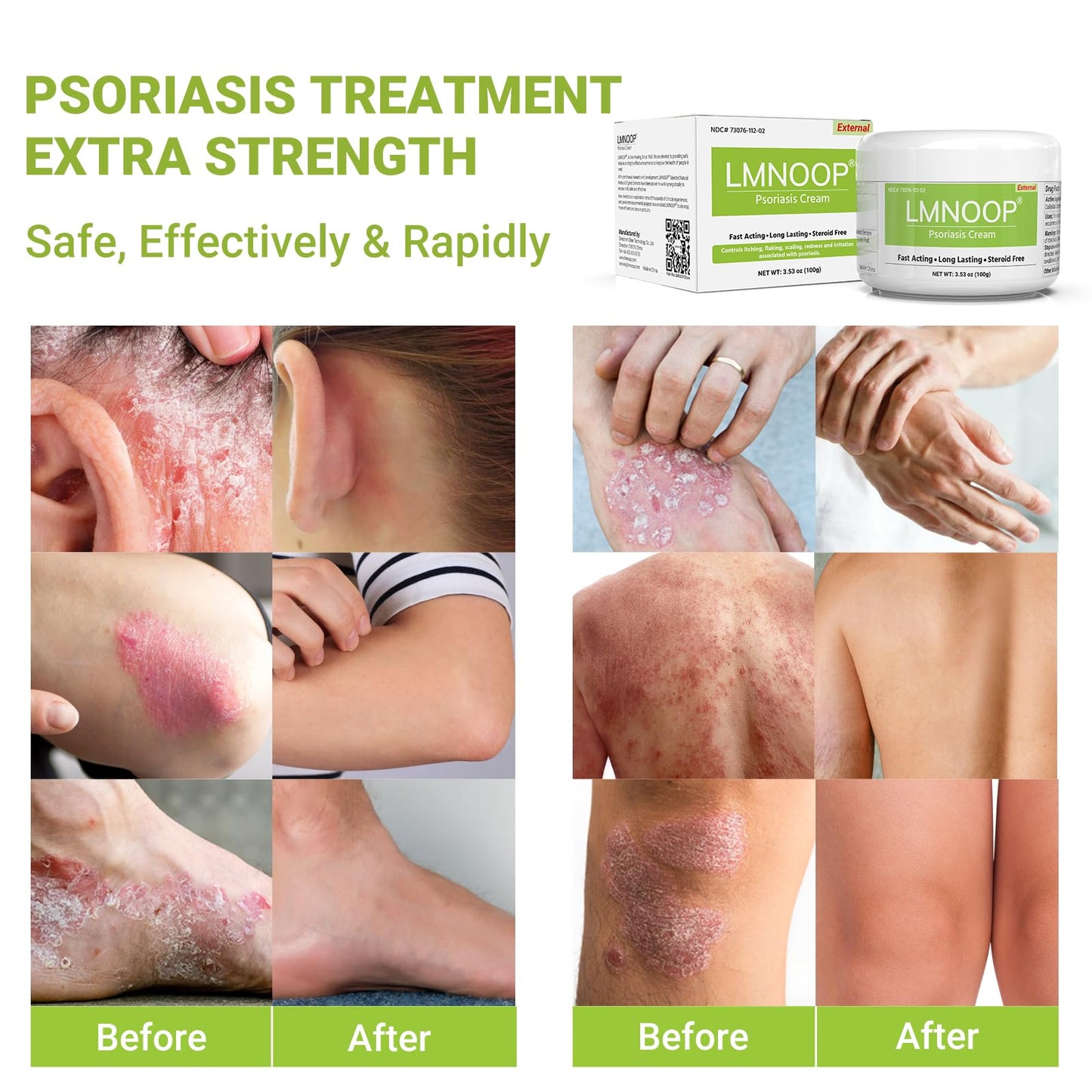 LMNOOP Psoriasis Cream, Maximum Strength Treatment Moisturizing Cream for Psoriasis, Dermatitis, Rash, Anti-Itch, Redness, Flaking, Scaling, Fast Acting Relief for Irritated, Dry Skin 3.53OZ