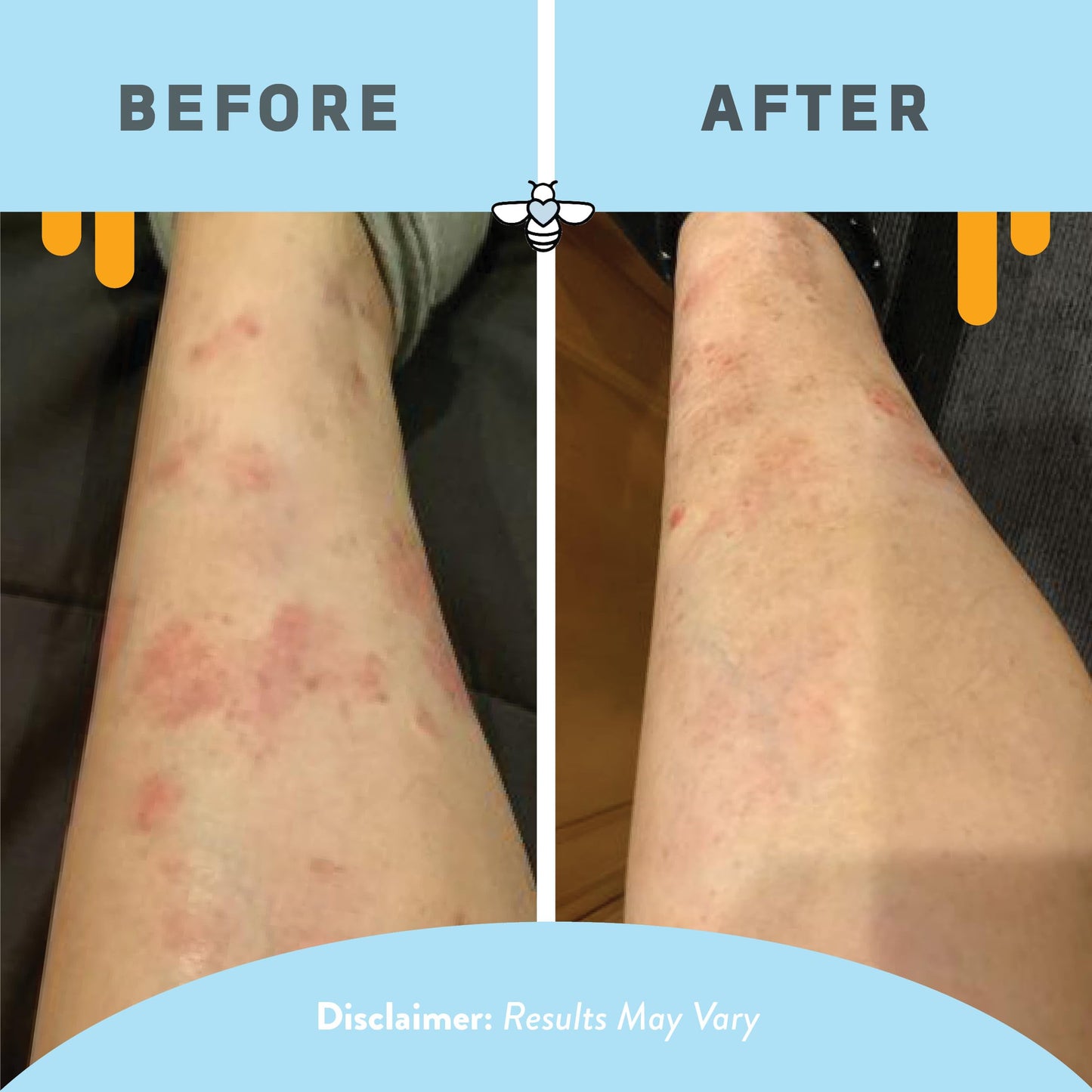 PSORIASIS HONEY Daily Moisturizing Body Lotion, for Itching Skin (16 oz)