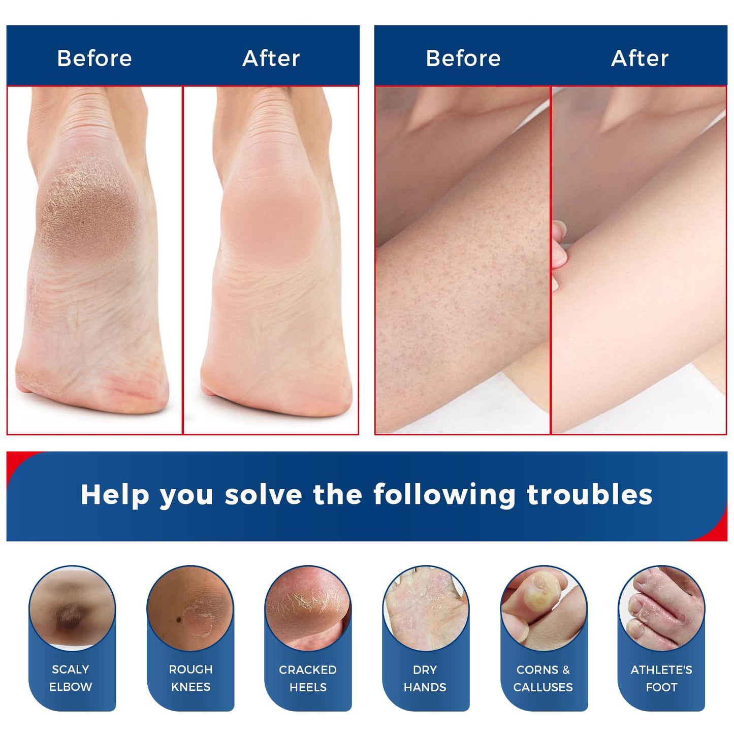 OUKEYA NEW FORMULA Urea Cream 40% Plus 2% Salicylic Acid for Feet Maximum Strength, Dry Cracked Hand Heel Moisturizing Repair Lotion for Knees, Elbows, Removes Corns, Dead Skin Cream, 5.29 oz