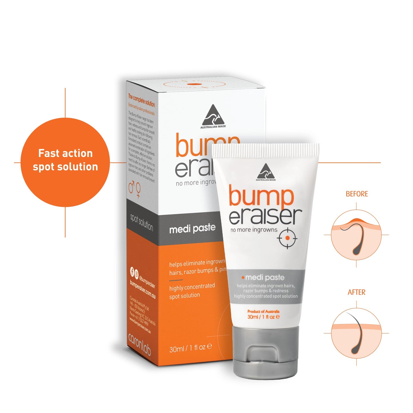 Bump eRaiser Medi Paste 1.0 fl oz — Tea Tree & Vitamin A Overnight Spot Care for Ingrown Hairs & Razor Bumps on Bikini Line, Legs, Beard & Underarms | Vegan | Made in Australia