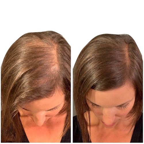 THICK FIBER Hair Fibers For Thinning Hair & Bald Spots (MEDIUM BROWN, Pack of 2) - 25g Bottle - Conceals Hair Loss in Seconds - Hair Powder For Women & Men