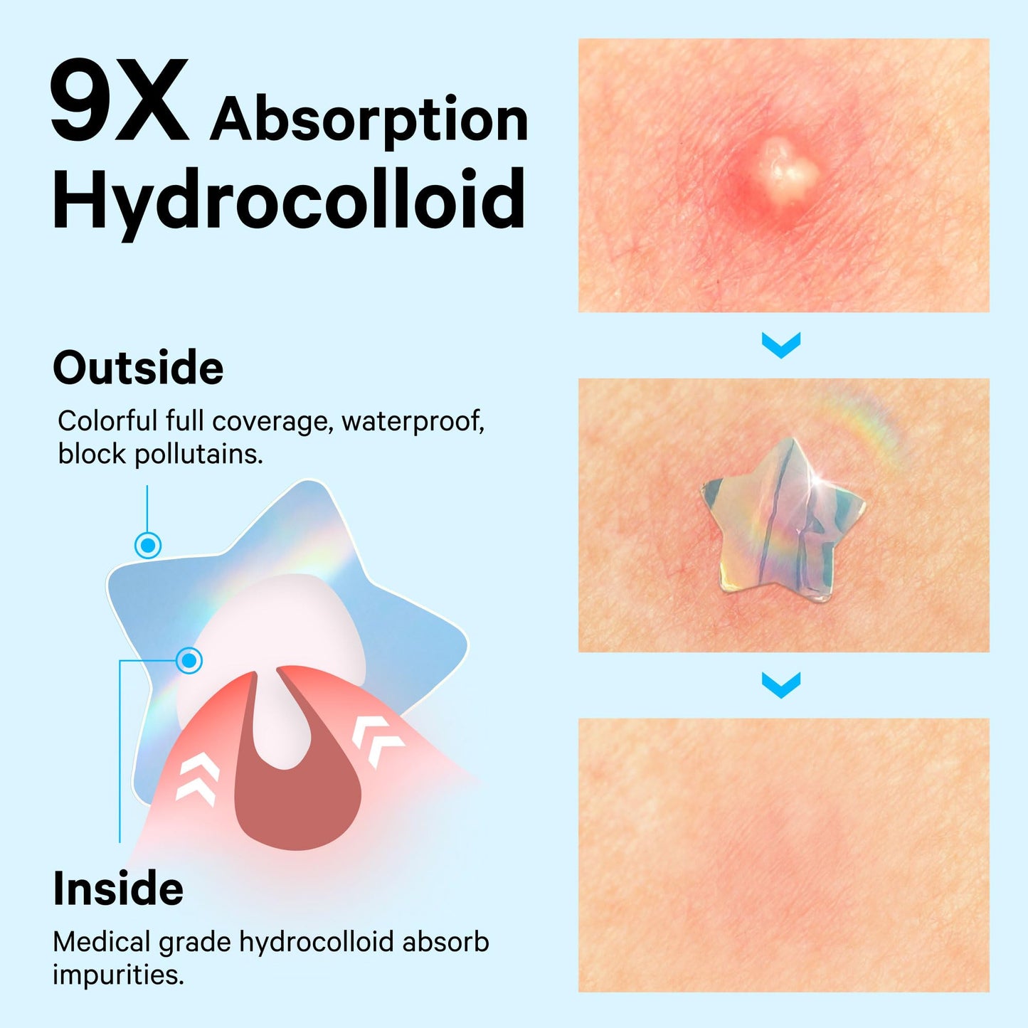Sosky Hologram Pimple Patches for Face, Hydrocolloid Acne Patches with Salicylic Acid, Cute Star Zit Stickers,Colorful Blemish Covers,48 Count Blue Cloud Butterfly