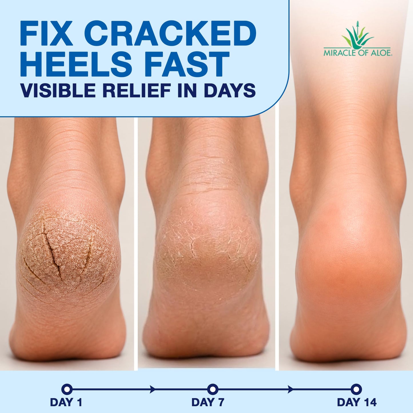Heel Balm for Dry Cracked Feet - Miracle Heel Stick for Cracked Heel Repair - Heel Balm Stick for Cracked Heel Treatment - Formulated with Pure Aloe Vera, Tea Tree Oil, Shea & Cocoa Butters | 2.5 oz