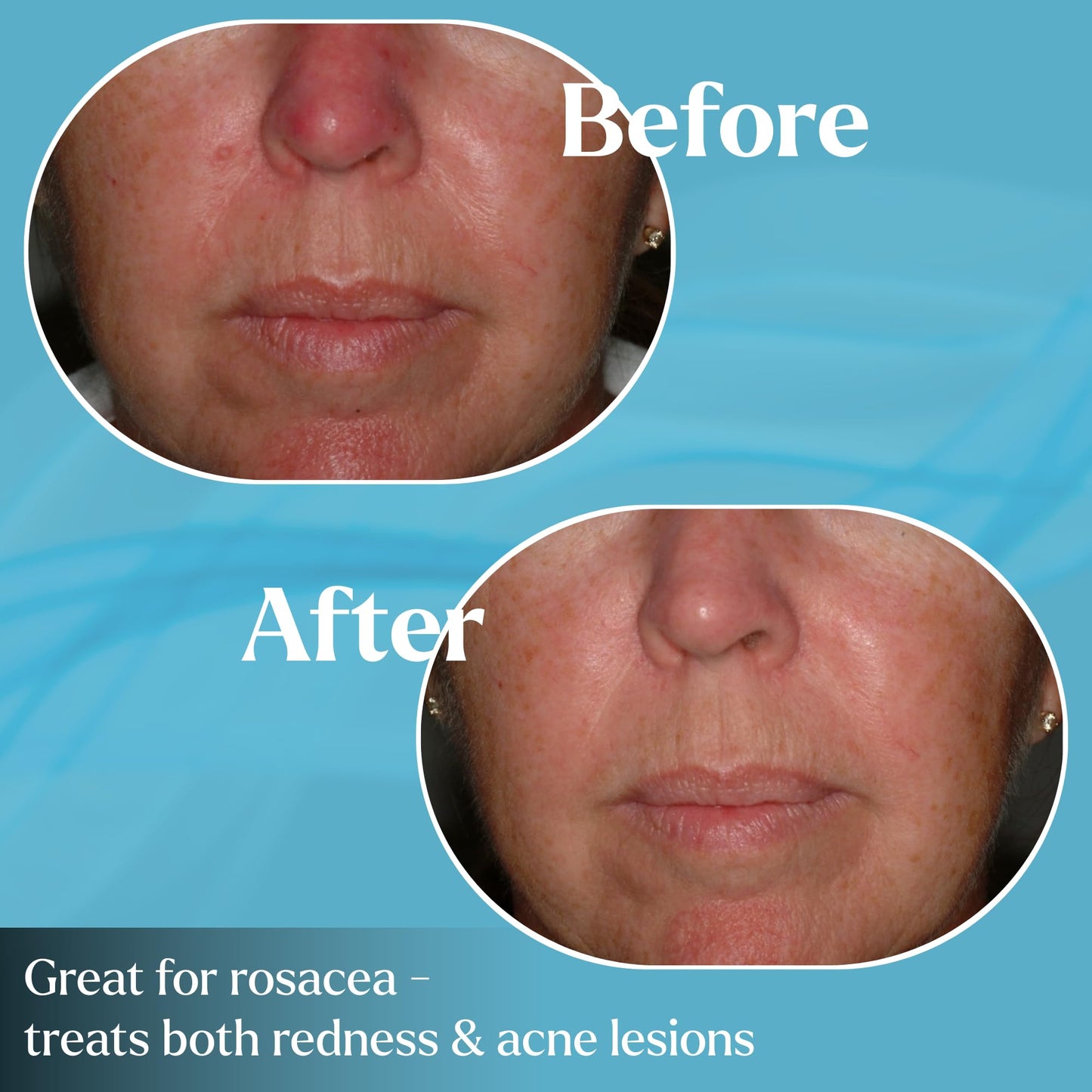 Advanced Pyratine A1 Soft Crème - Cytokinin Antiaging & Rosacea Treatment - Skin Cream Reduces Facial Redness, Acne Lesions, Spider Veins, Fine Lines, Wrinkles, & Mottled Hyperpigmentation - 2 oz.