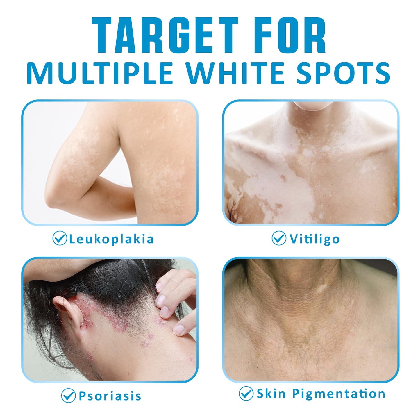 VEXWOLQ Vitiligo Cream, Natural Vitiligo Treatment Cream for Skin Vitiligo-Improve Pigmentation & Fade White Spots, Skin Topical Cream with Gentle Formula for women & men, 20g