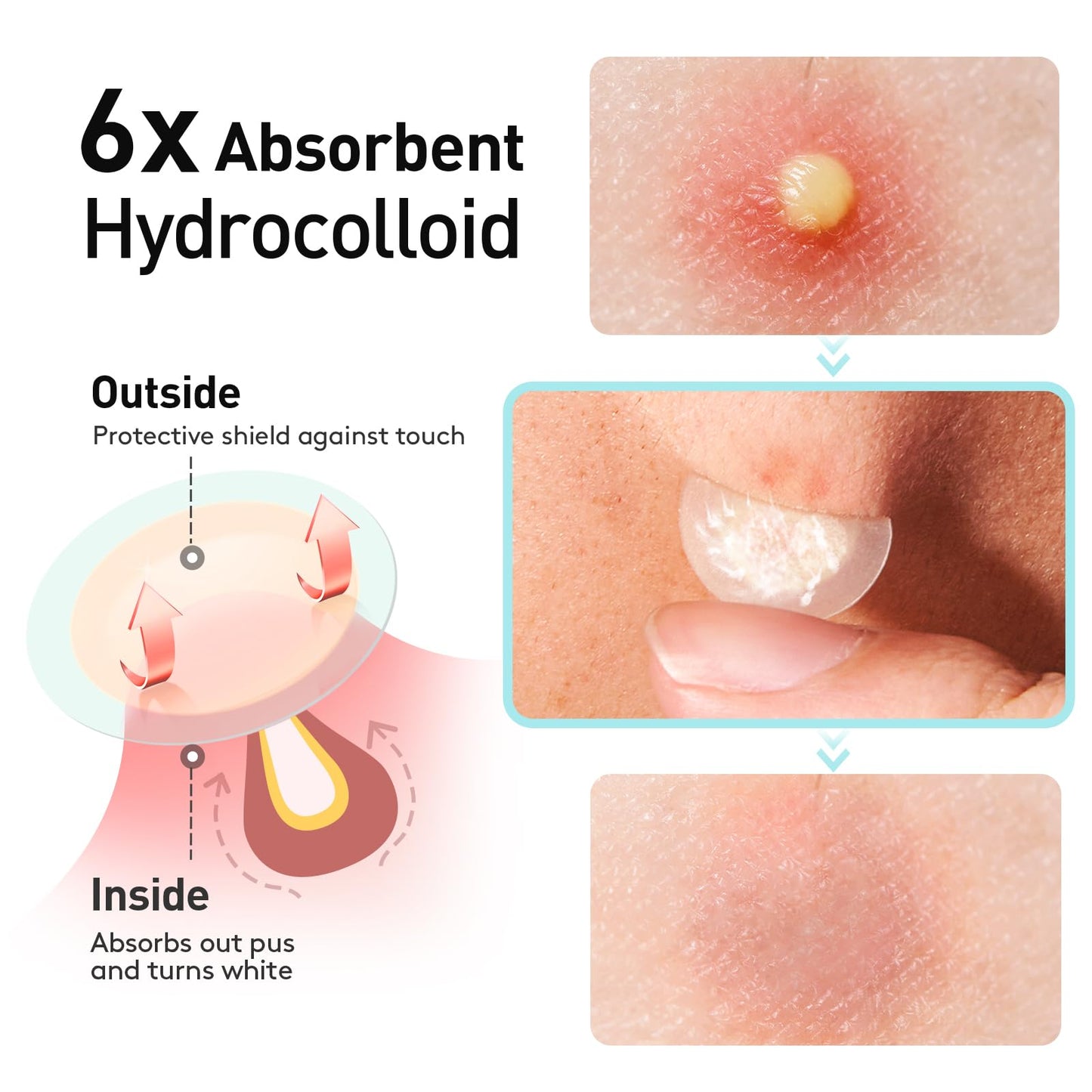 Pimple Patches, 15 mm Invisible Acne Patches for Face with Salicylic Acid, 0.01cm Extra Thin Outer Edge, Hydrocolloid Zit Patch for Pustule, Whitehead, Cystic Acne Spot, 96 Count