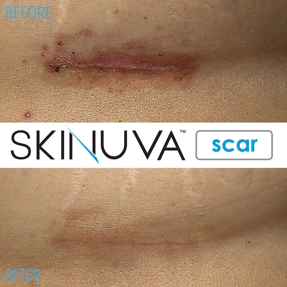 Skinuva® Scar Cream for Face & Body (1.5 oz)
