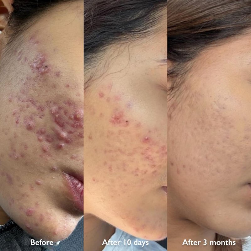 Orbe It! 2-Step Acne Treatment - Salicylic Acid Spray & Cream for Face & Body | Unclogs Pores, Reduces Pimples & Back Acne