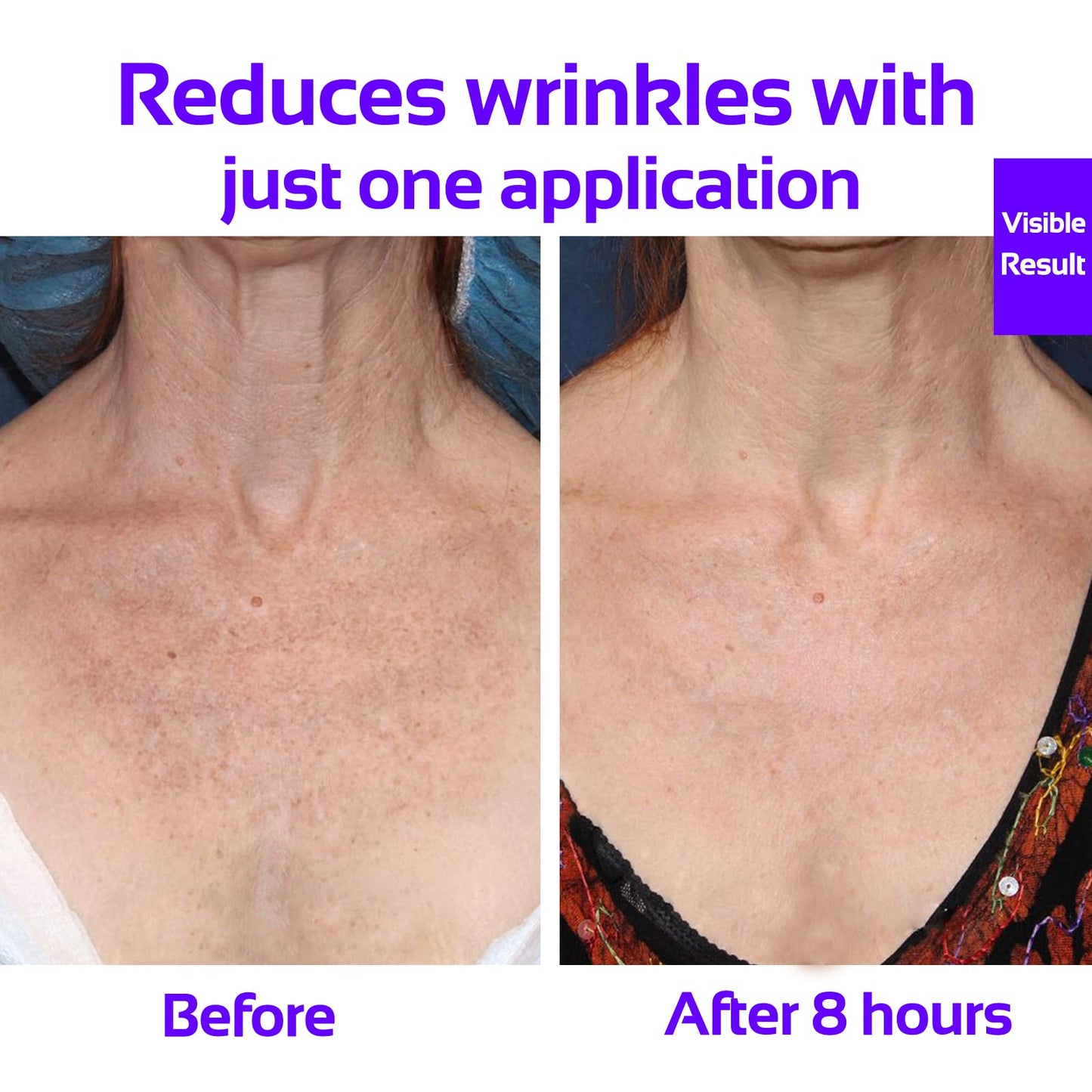 Skywee Professional Products Anti Wrinkle Chest Silicone Pad, Resuable and 100% Medical Grade Décolleté Anti Wrinkle Patches, Smooth Your Skin Set of 2