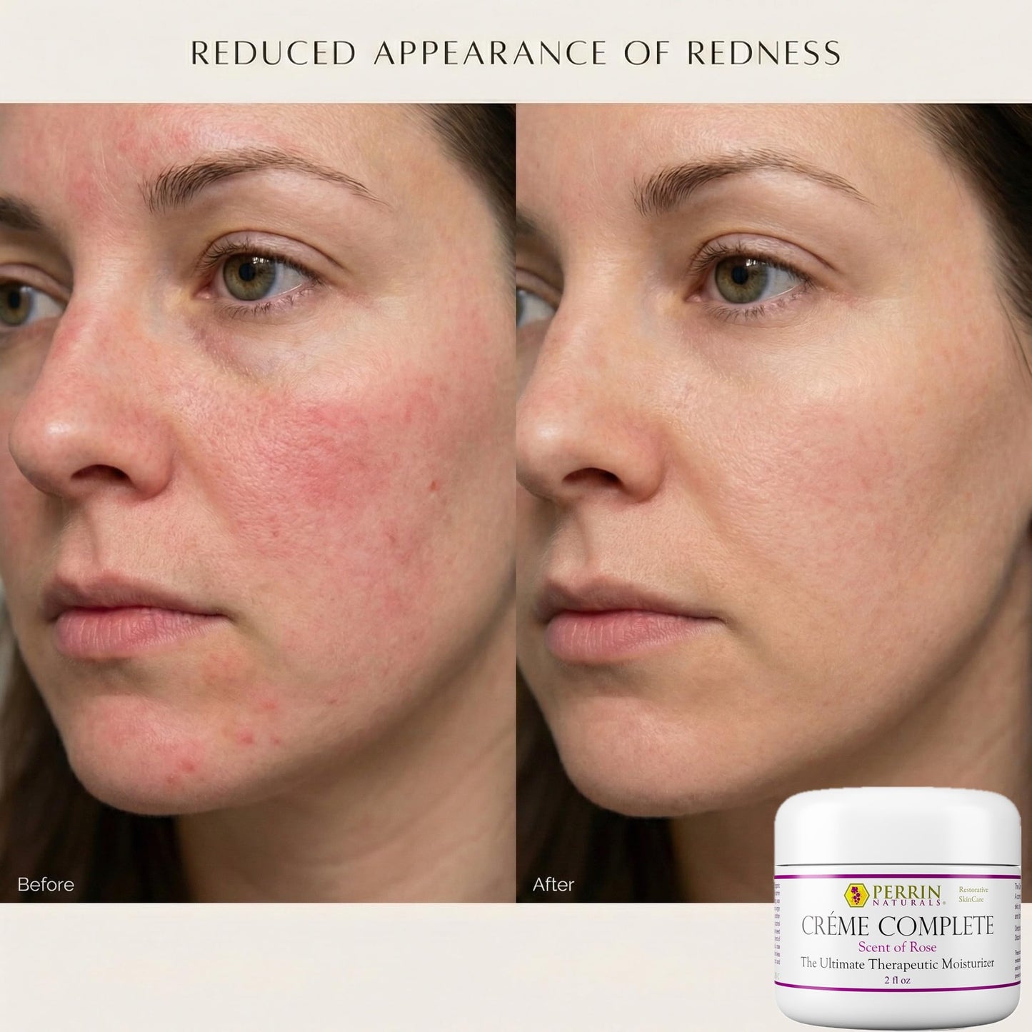 Perrin Naturals Crème Complete, Lichen Sclerosus treatment Cream for Dry Sensitive Skin, Restorative Anti Aging Face & Body Moisturizer with Barrier Support for Women, Scent of Rose, 2 oz