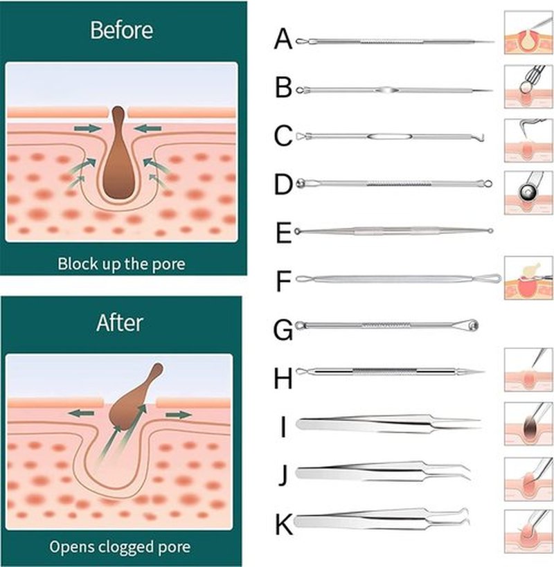 Usiveinborn Blackhead Remover, Usiveinborn Tweezers, Professional Facial Blackhead Remover Tweezers, Blackhead Remover Comedone Extractor (Slant-Mouth clamp)