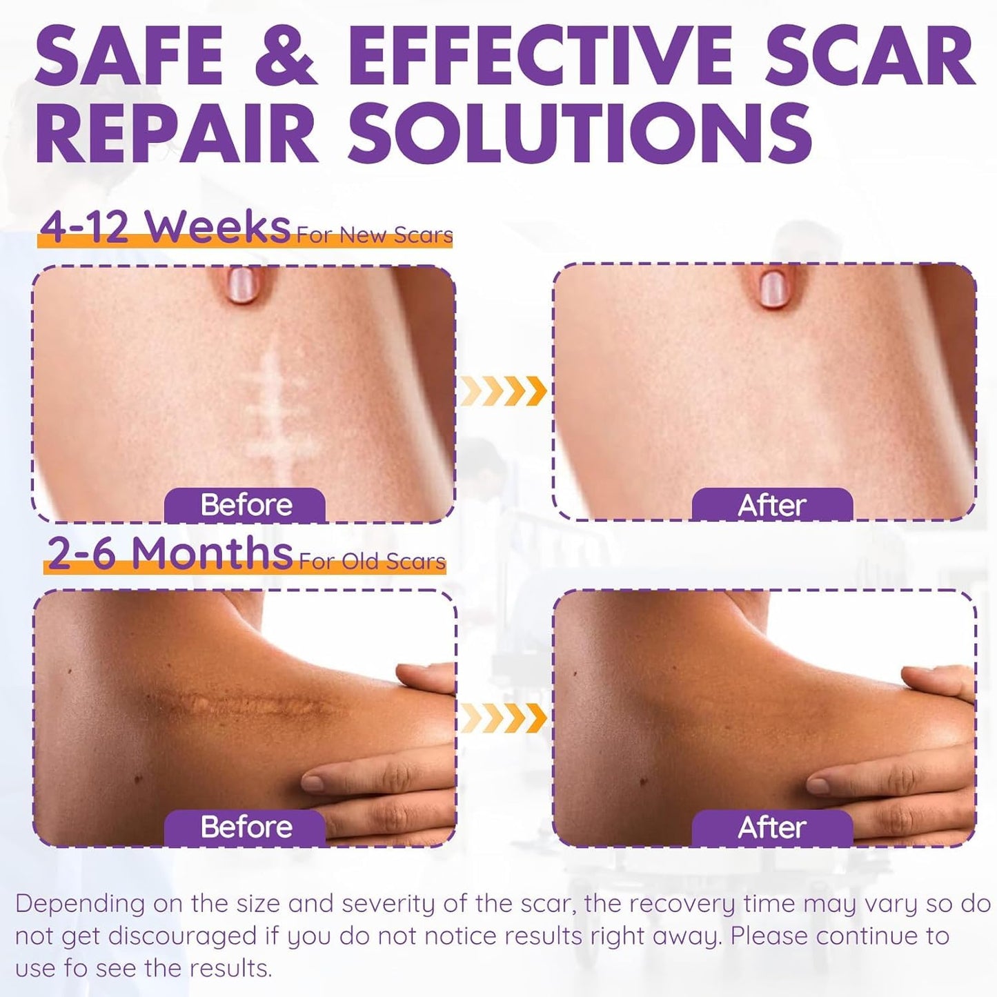 Silicone Scar Sheets, Silicone Scar Tape(1.6"x 118" Roll-3M)