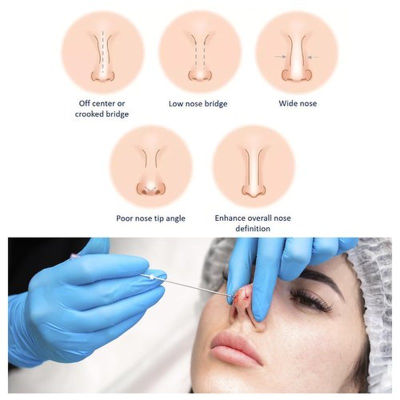 ESTEVO PDO Nose Cog Threads Lift L-Blunt 360° All Round 4D Sawtooth Lifting PDO Cog Thread (16PCS-19G*60mm)