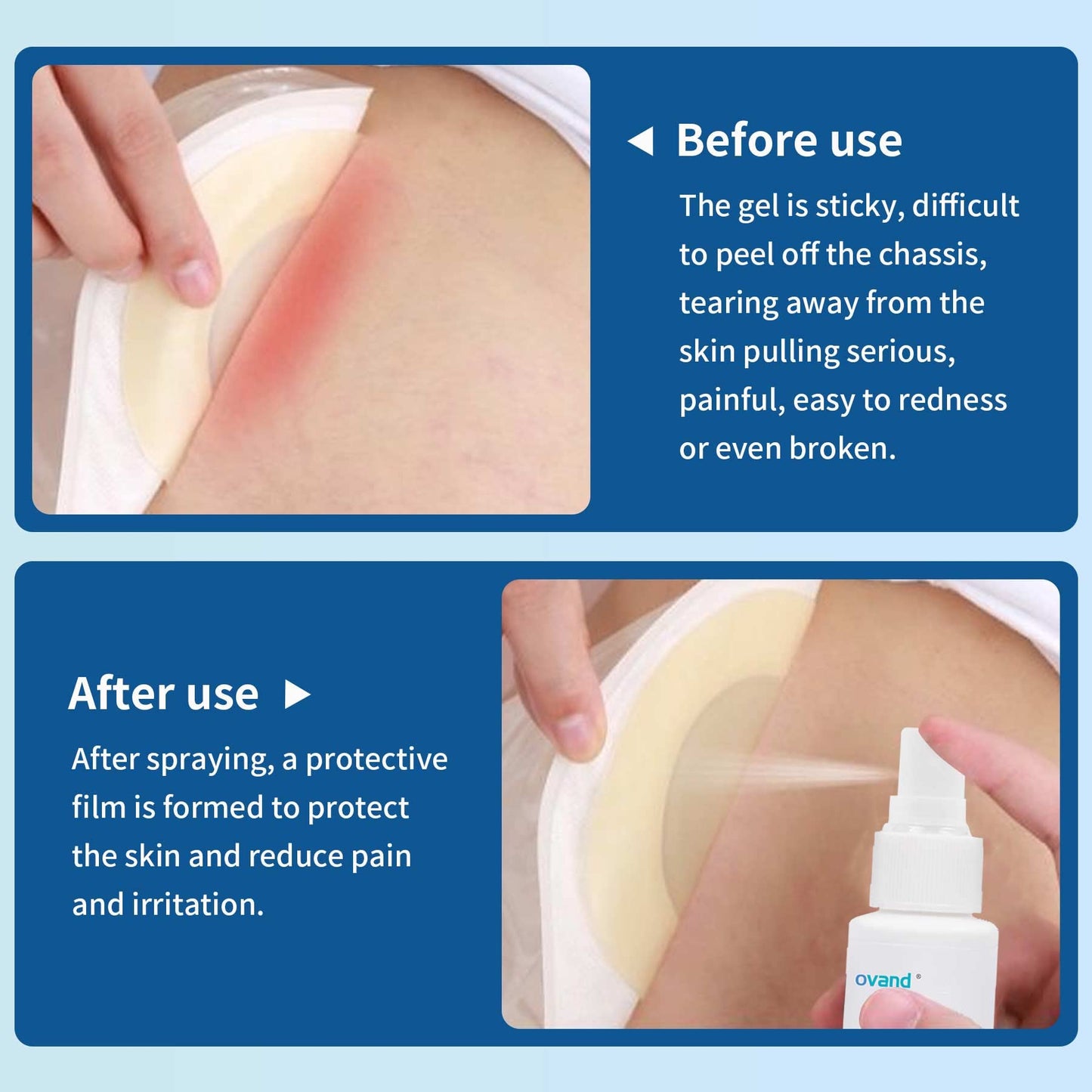 No Sting Ostomy Barrier Spray - Skin Barrier Film for Sensitive Skin - Skin Barrier for Protection Around Stomas and Wounds