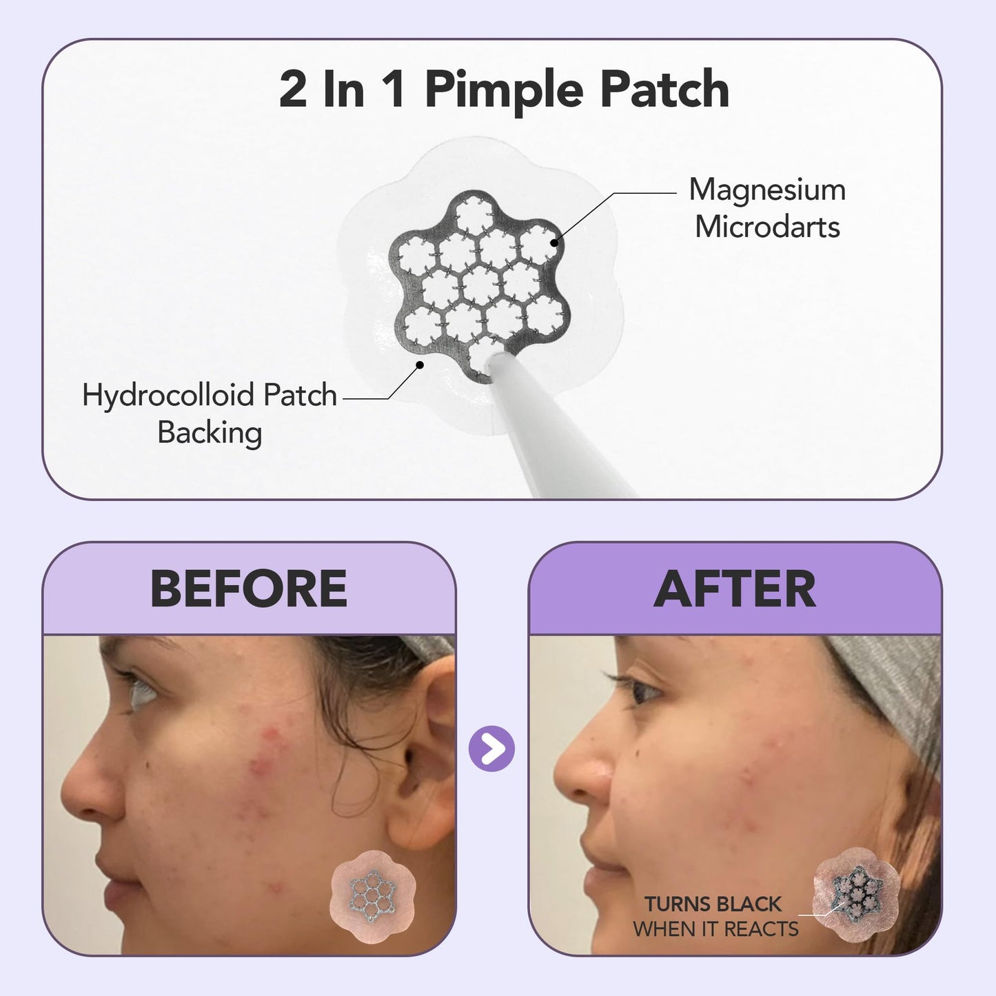 FreeGo Magnesium Blemish Microdarts Pimple Patch | Fast-Acting | Quick Calming | 99.9% Pure Magnesium | Madecassic Acid | Tea Tree | Eucalyptus Leaf | Hydrocolloid Spot Patch | Mini 2 Packs 30 Patches