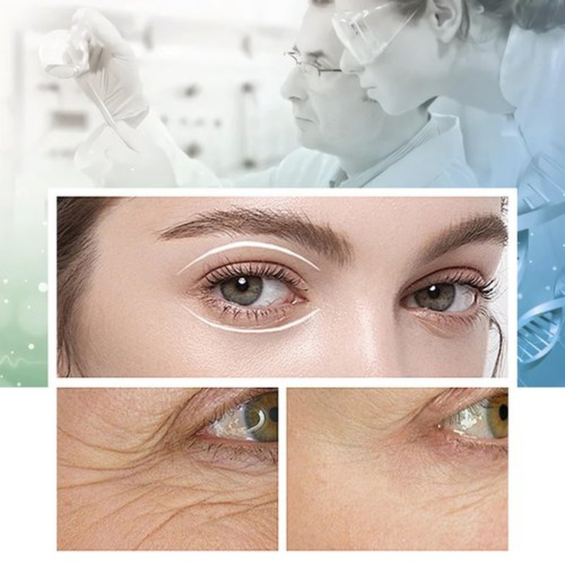 ESTEVO PDO Eyes Thread Lift, Improves Fine Lines and Wrinkles Get Youthful PDO Threads Lift for Eyes (20PCS-30G*38mm)