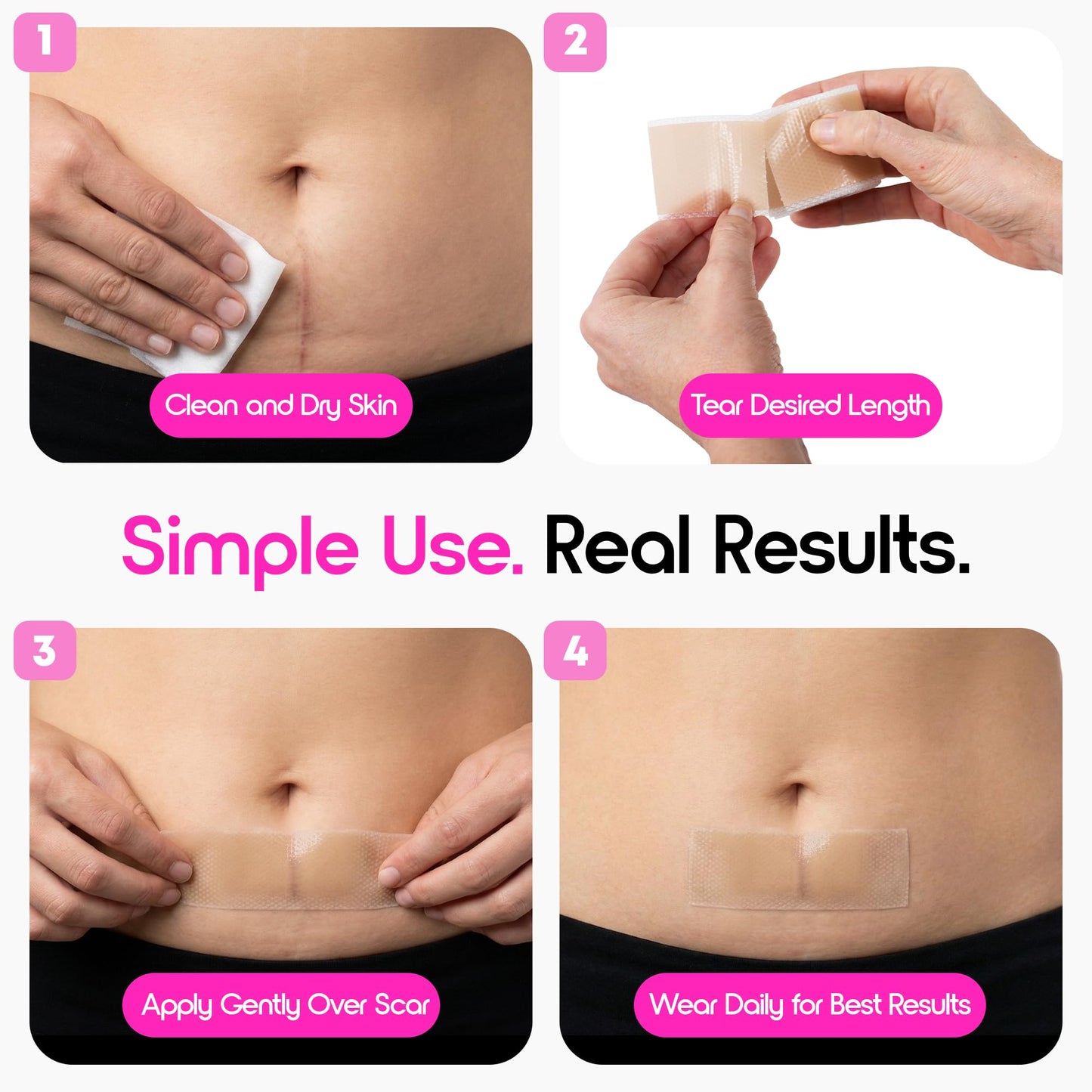 MOMPACT Silicone Scar Sheets, Medical Grade Silicone Scar Tape, Extra Long (1.6"X 120" Roll-3M) Scar Tape for Surgical Scars Removal Strips, Keloid Bump Removal for C-Section,Tummy Tuck, Wrinkles