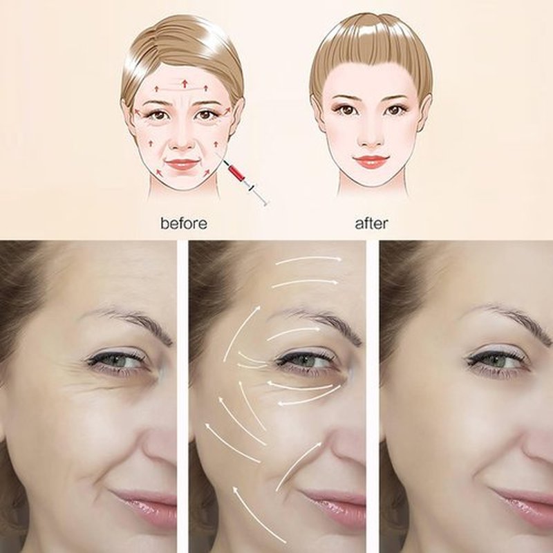 ESTEVO PDO Screw Thread, Improves Skin, Lift and Restore Skin Elasticity and Radiance, Pdo Thread Increase Firmness (20PCS-27G*50mm)
