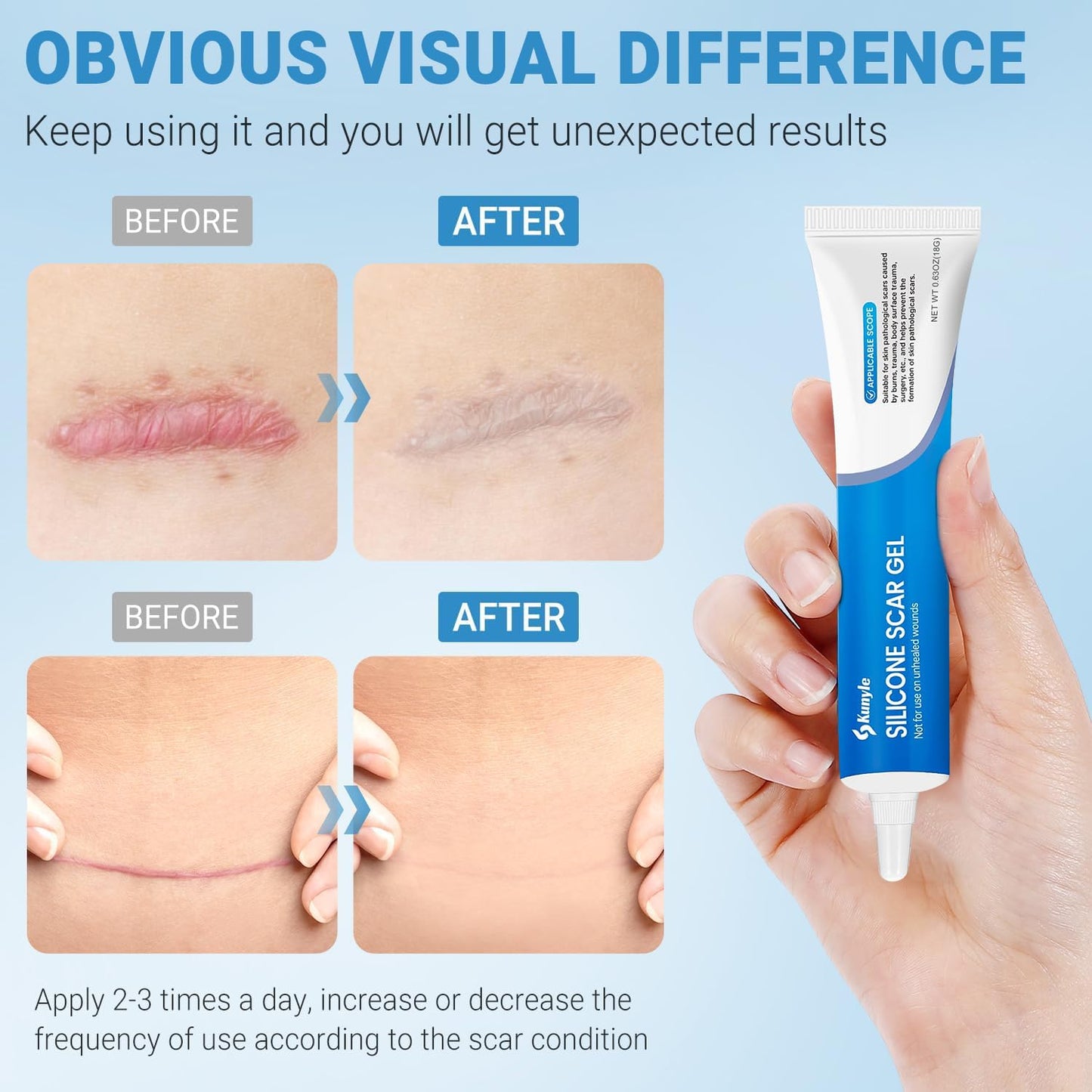 Kunyle 100% Silicone Scar Gel, Scar Cream, Advanced Scar Stick for Surgical Scars, Stretch Marks, Keloid Bump Removal, Old and New Scars 0.63oz (18g)