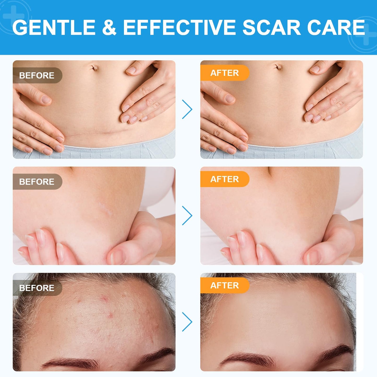 Silicone Scar Sheets, (1.6"X120" Roll-3M) Silicone Scar Tape, Scar Tape for Surgical Scars, Medical Grade Scar Tape with Collagen,For Surgical,C-Section,Tummy Tuck,Keloid Scars, Keloid Bump Removal