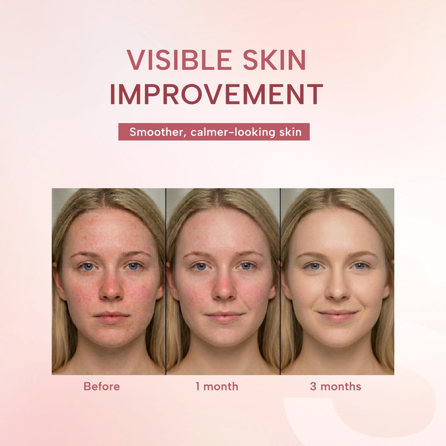 suquato 10% Azelaic Acid Cream – Rosacea Treatment for Face & Redness Reducing Face Cream – Redness & Blemish Care for Sensitive Skin – Lightweight Daily Use 30g