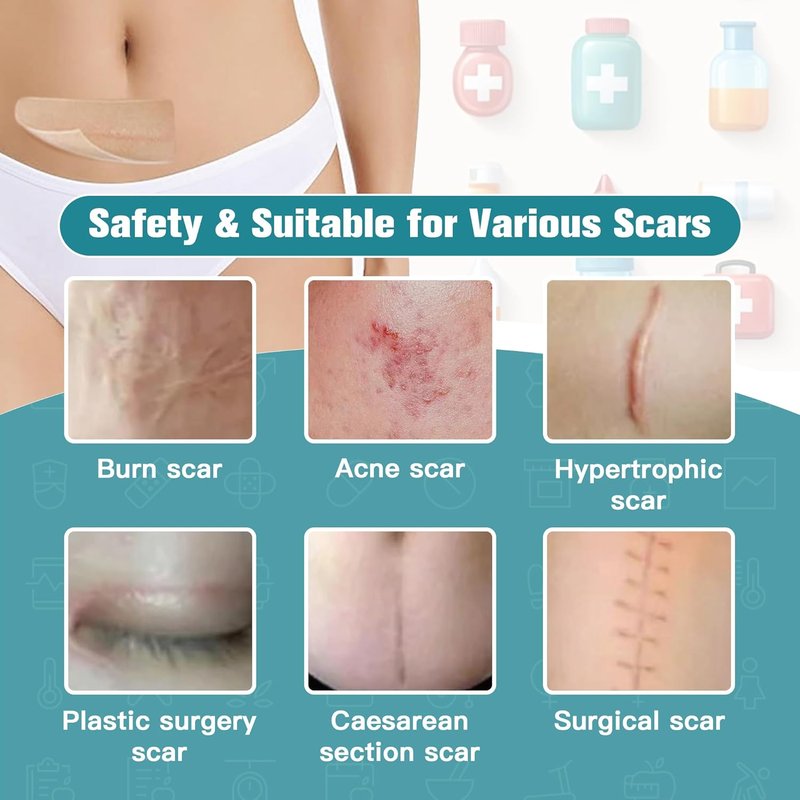 Silicone Scar Sheets - Ultra-Thin Scar Removal Tape for Surgical Scars | 1.6” x 120" Roll