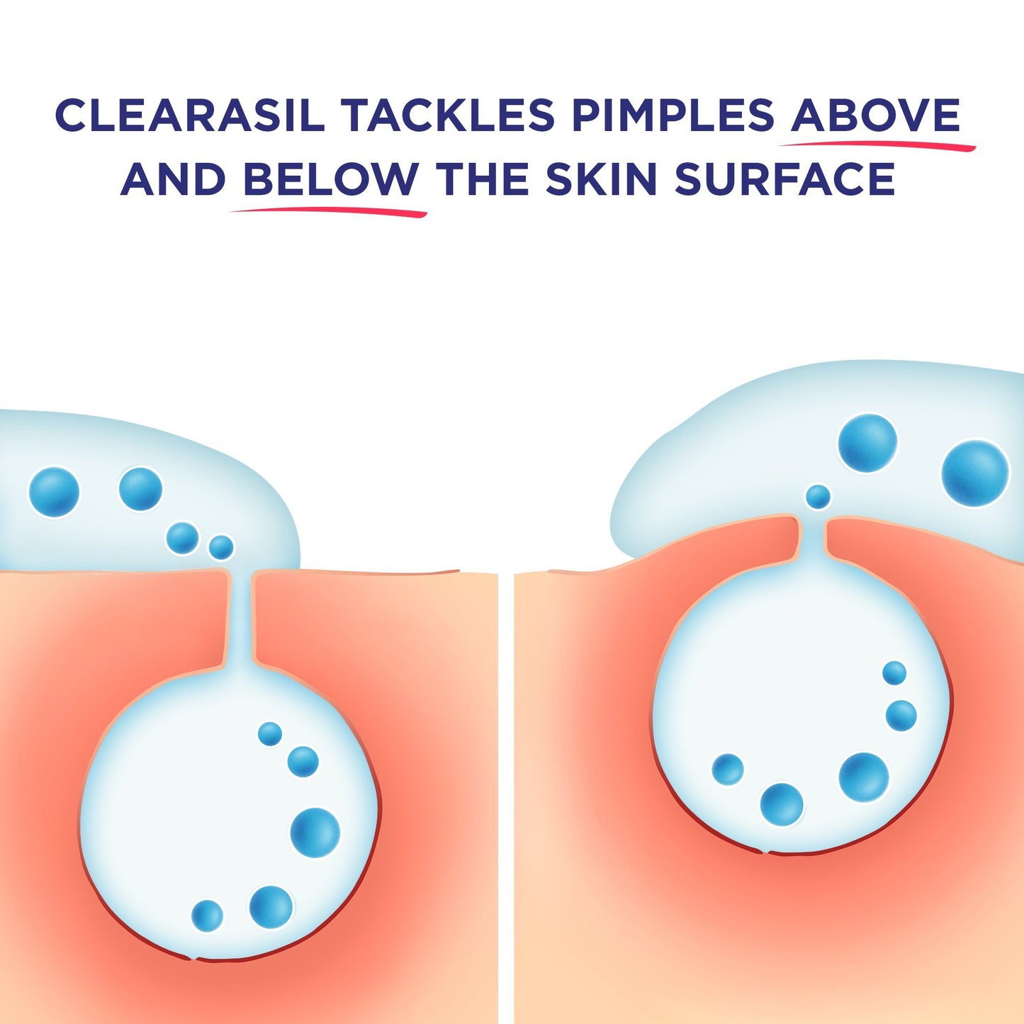 Clearasil Stubborn Acne Control 5in1 Weekly Scrub, 5 oz. (Packaging may vary)