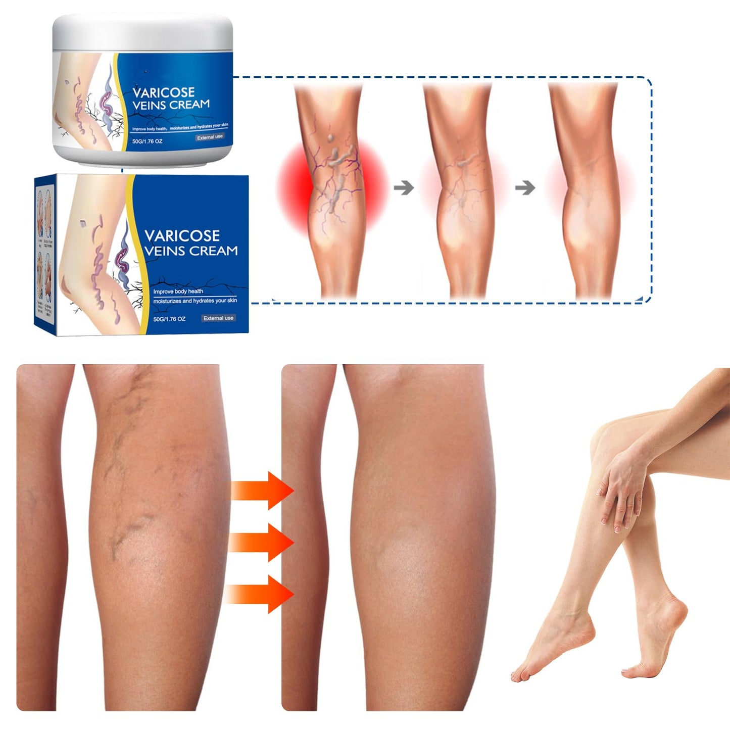 2Pcs Varicose Veins Treatment Cream for Legs Natural Ingredients, Suitable for Most Skin Types