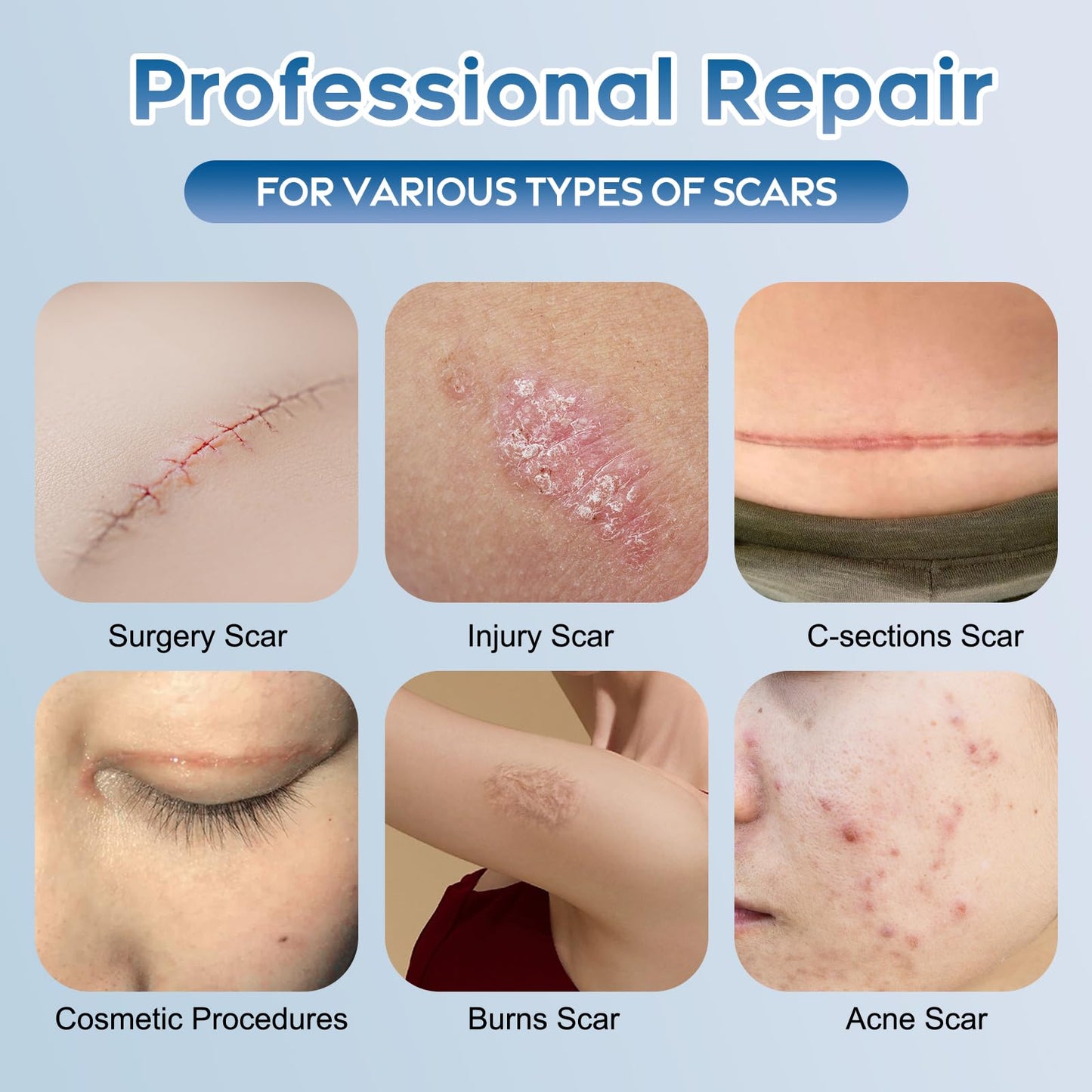 Advanced Silicone Scar Gel for Face & Body – Silicone Scar Cream for Old & New Scars, Reduces Appearance of Scars from Acne, Surgery, Burns, Injuries, C-Sections & More – 3.53 oz (100g)