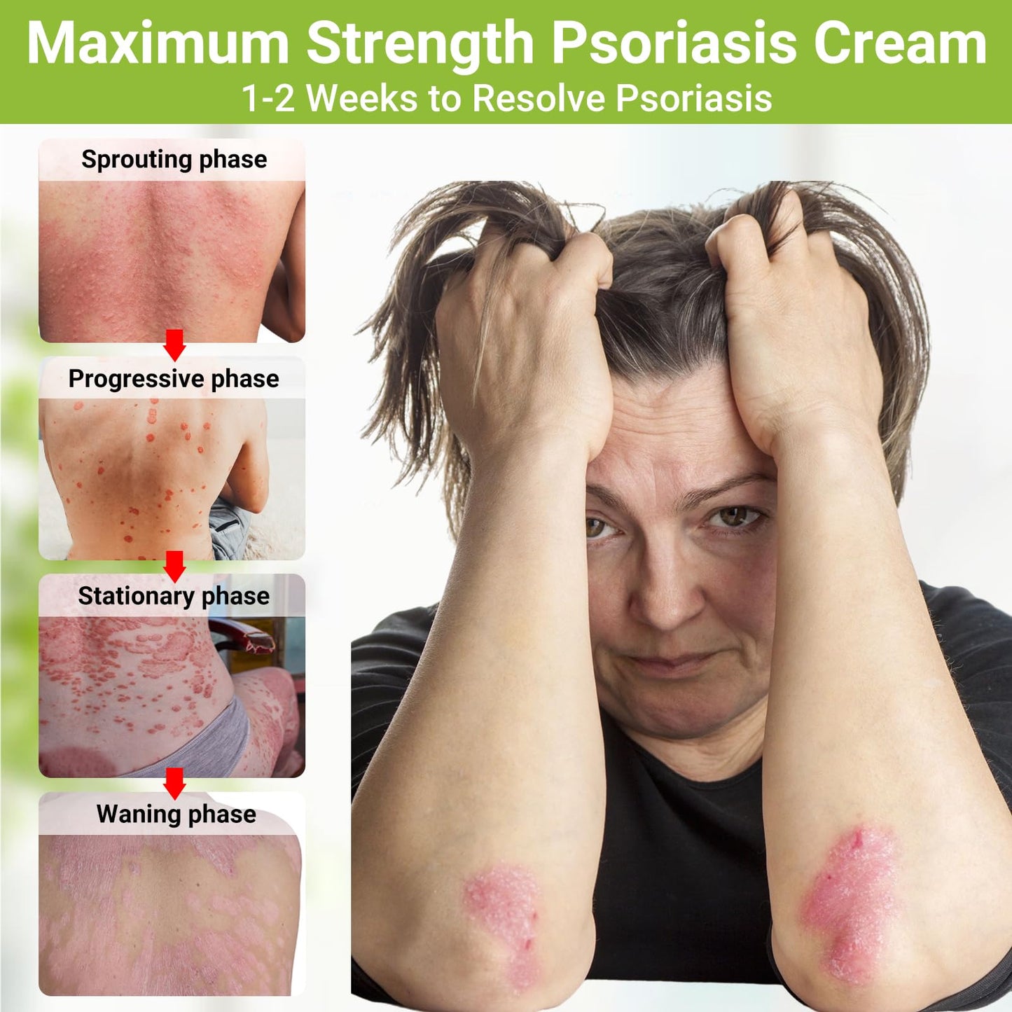 LMNOOP Psoriasis Cream, Maximum Strength Treatment Moisturizing Cream for Psoriasis, Dermatitis, Rash, Anti-Itch, Redness, Flaking, Scaling, Fast Acting Relief for Irritated, Dry Skin 3.53OZ