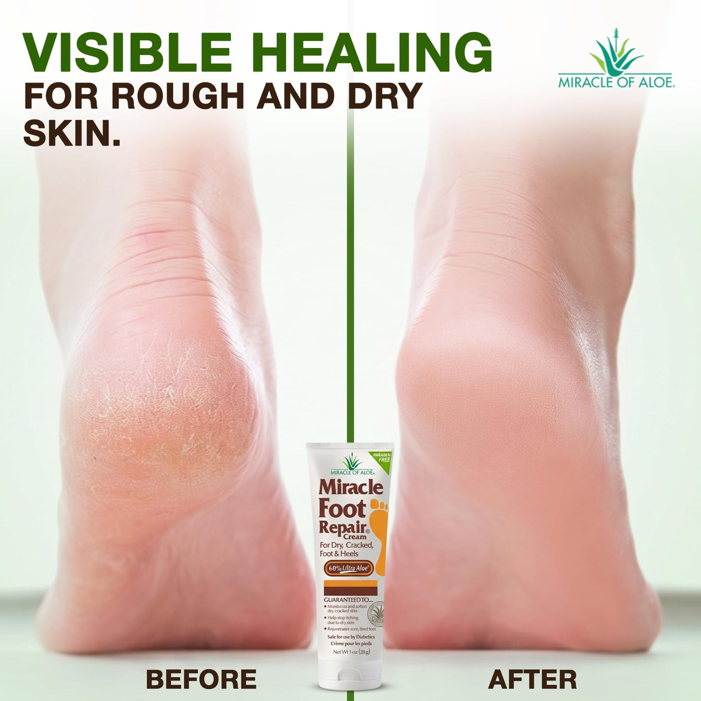 Miracle Foot Repair Cream (8 oz & 1 oz) Repairs Dry Cracked Heels and Feet, 60% Pure UltraAloe Moisturizes, Softens, and Repairs