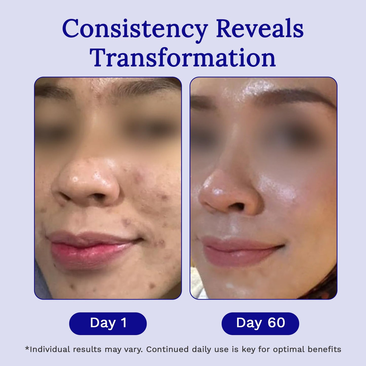 Rejûvaskin RejûvaSil Silicone Scar Gel, Medical Grade Scar Removal Gel for Surgical Scars, Keloids, Burns & Acne, With Vitamin C, Emu Oil & Squalane to Soften & Flatten, 10 mL