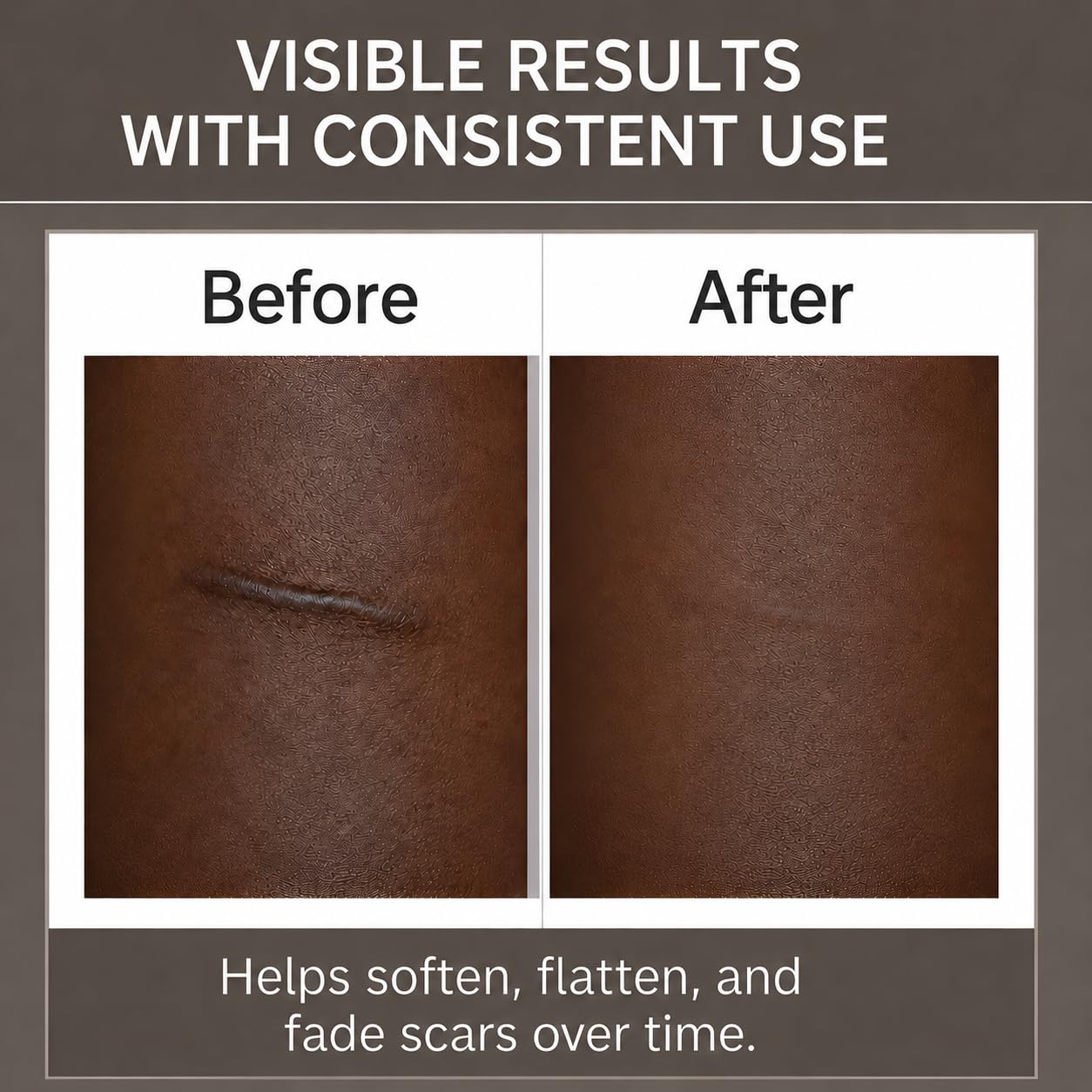 Nugexa Silicone Scar Tape & Sheets – All Skin Tones, Medical Grade