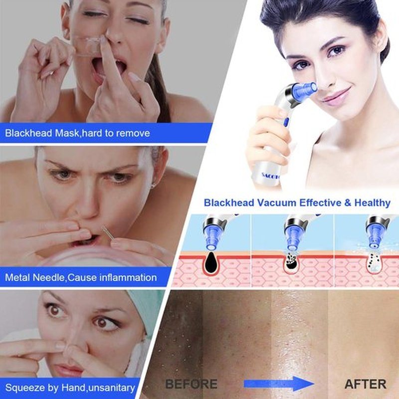 Blackhead Remover Pore Vacuum, Face Suction Pore Cleaner, 5 Suction Power Electric Blackhead Suction Remover, Extractor Tool, 4 Probes for Women & Men (Blue）