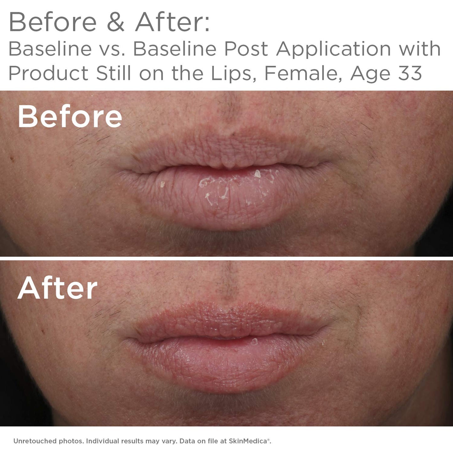 SkinMedica HA5 Smooth & Plump Lip System - Your Hydrating, Volumizing Lip Plumper for Visibly Fuller and Smoother Lips, 0.05 Oz