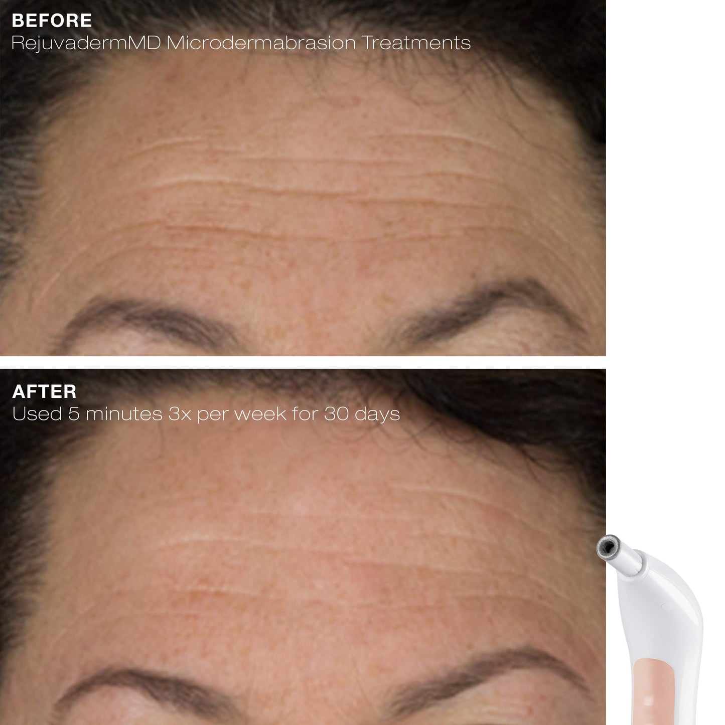 Trophy Skin RejuvadermMD - Microdermabrasion Machine On-The-Go - Facial Exfoliation with Real Diamond Tip for Radiant and Youthful Skin