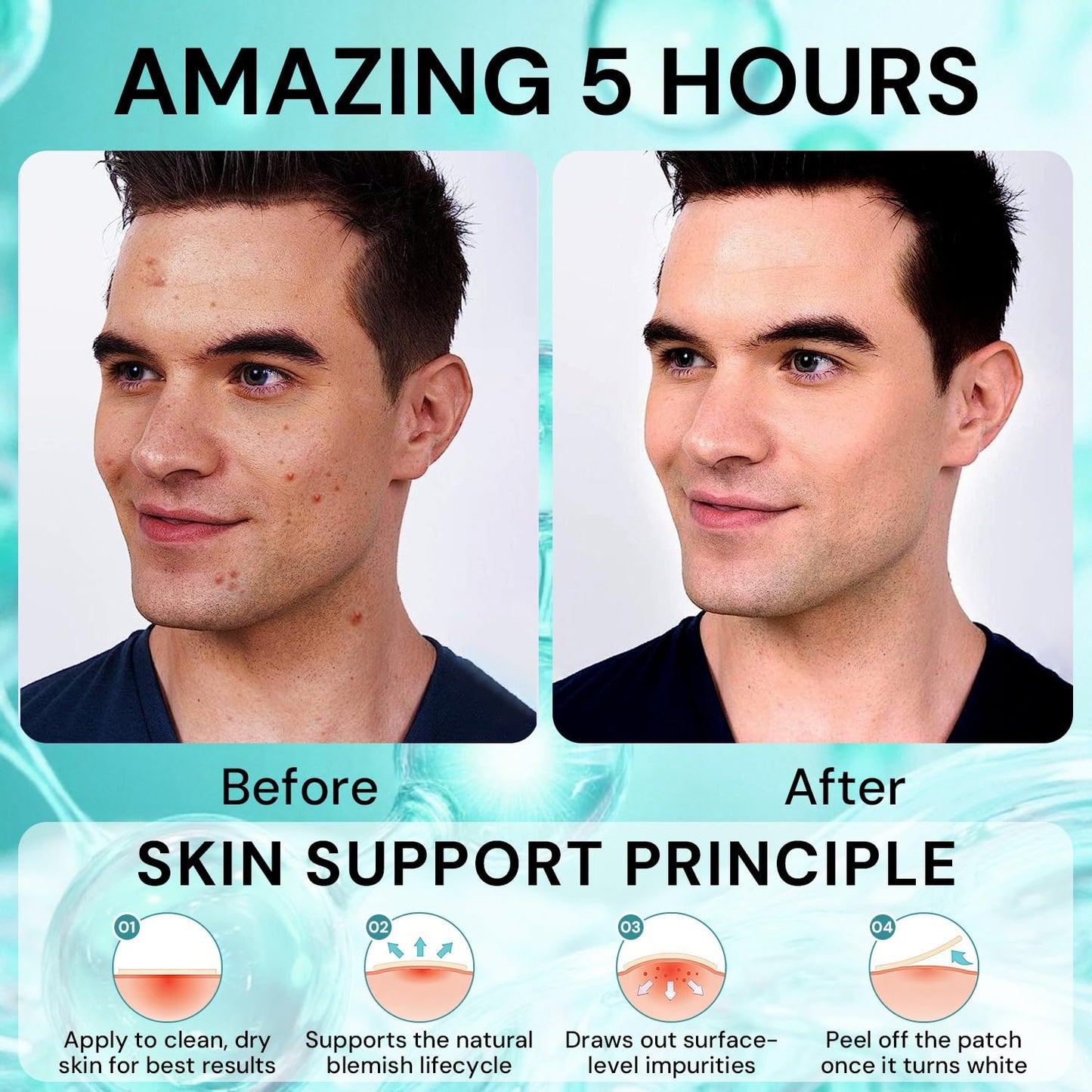 Hydrocolloid Acne Pimple Patches for Face – Nighttime Spot Stickers for Zits & Blemishes, Acne Healing Dots with Salicylic Acid, Korean Skincare Spot Treatment,Suitable Under Makeup