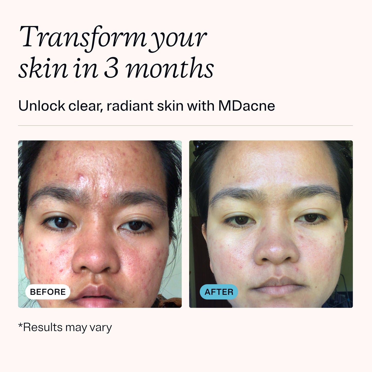 MDacne 3 Step Face Acne Treatment Kit, Benzoyl Peroxide Cream 2.5%, Salicylic Acid Cleanser, Niacinamide Moisturizer – Medicated Plant-Based Skincare for Adult & Teen Acne, 30 Day Kit