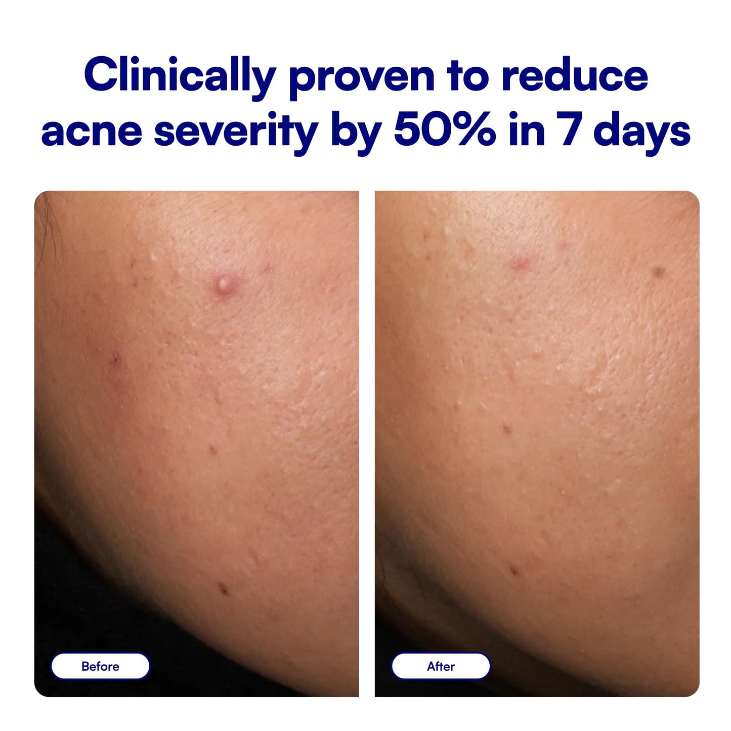 Bliss Clear Genius Acne Spot Treatment – Maximum Strength 2% Salicylic Acid Shrinks Blemishes – Clean, Vegan, Cruelty-Free, 0.5 Fl Oz