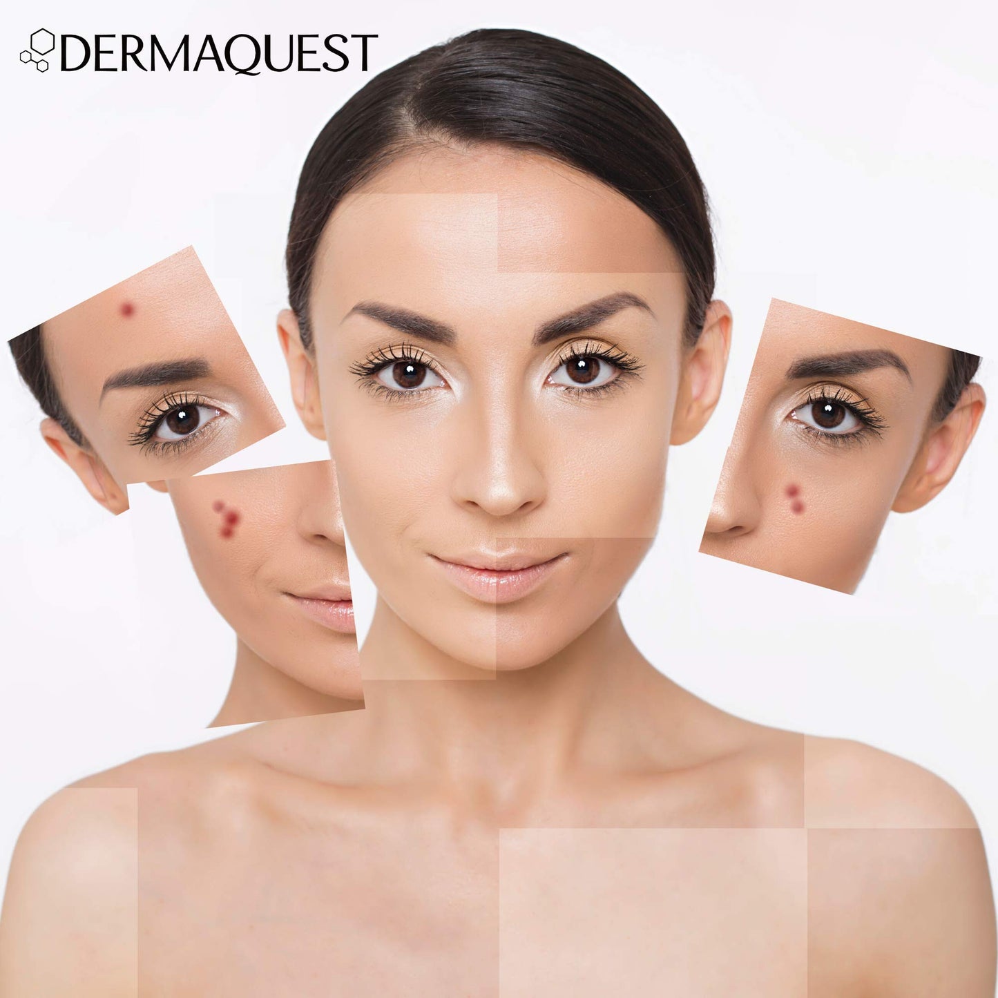 DermaQuest DermaClear Acne Treatment Kit - Acne Salicylic Acid Serum, Acne Facial Cleanser, Zinc Oxide Sunscreen, B5 Moisturizer - Skin Care and Acne Treatment for Oily & Sensitive Skin ($115 Value)