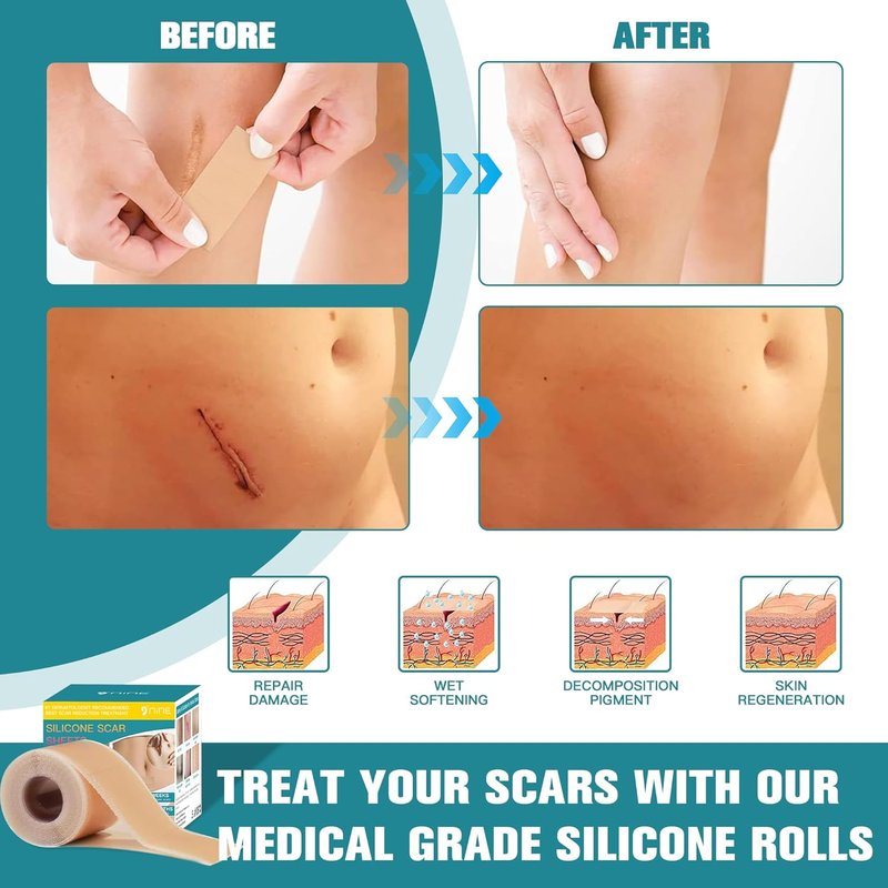 Silicone Scar Sheets - Ultra-Thin Scar Removal Tape for Surgical Scars | 1.6” x 120" Roll