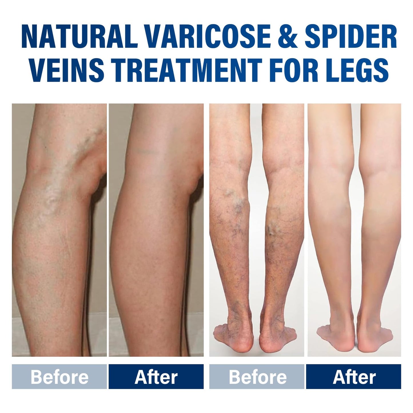 CURECURE Varicose Veins Treatment for Legs, Varicose Veins Treatment Cream- Improves Blood Circulation, Reduces Varicose Veins and Heaviness, 2 Count