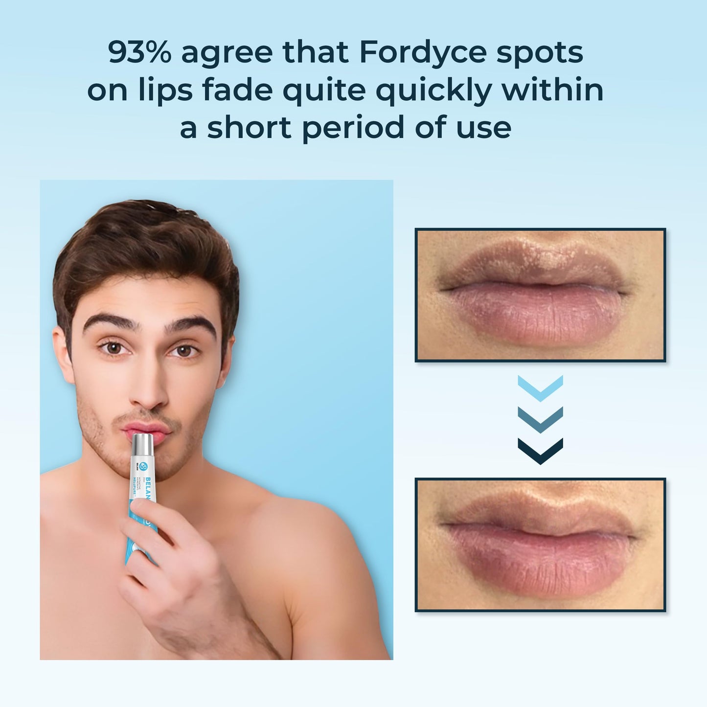 Belani Fordyce Cream - Helps Reduce Fordyce Spots, Daily Hydrating Lip Care for Dry, Chapped & Dark Sensitive Lips with Sunflower Oil, Lotus Extract & Shea Butter (0.7 Oz)