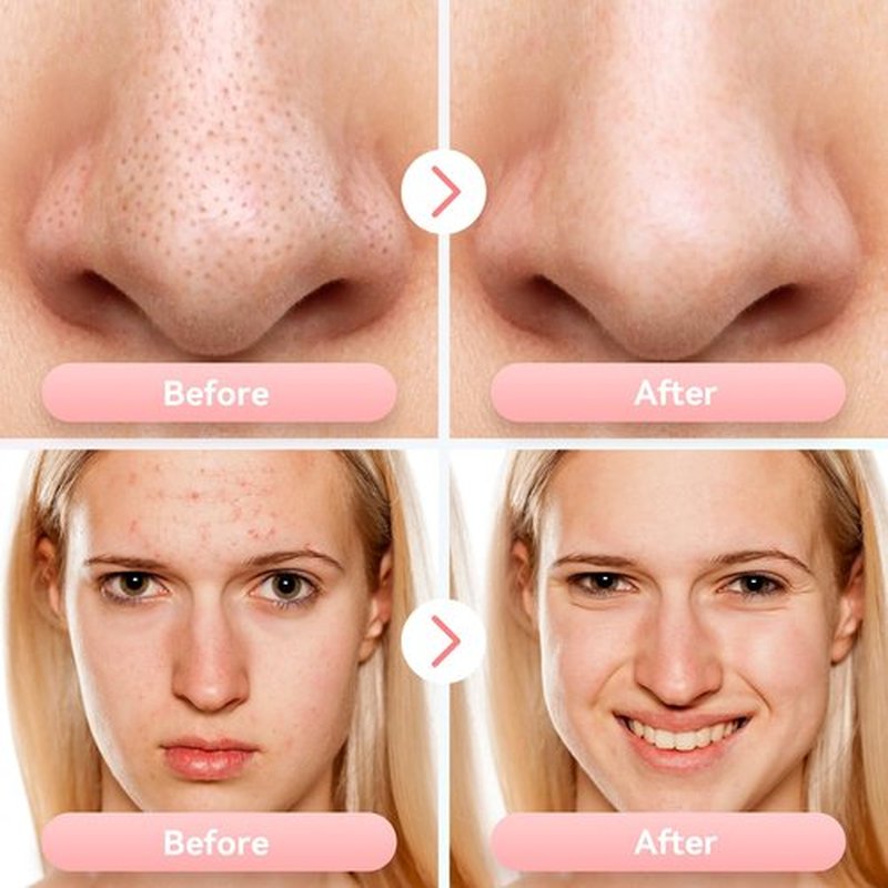Blackhead Remover Pore Vacuum Upgraded Facial Pore Cleaner Electric Comedone Whitehead Extractor Tool-5 Suction Power,5 Probes,USB Rechargeable Blackhead Vacuum Kit for Women & Men