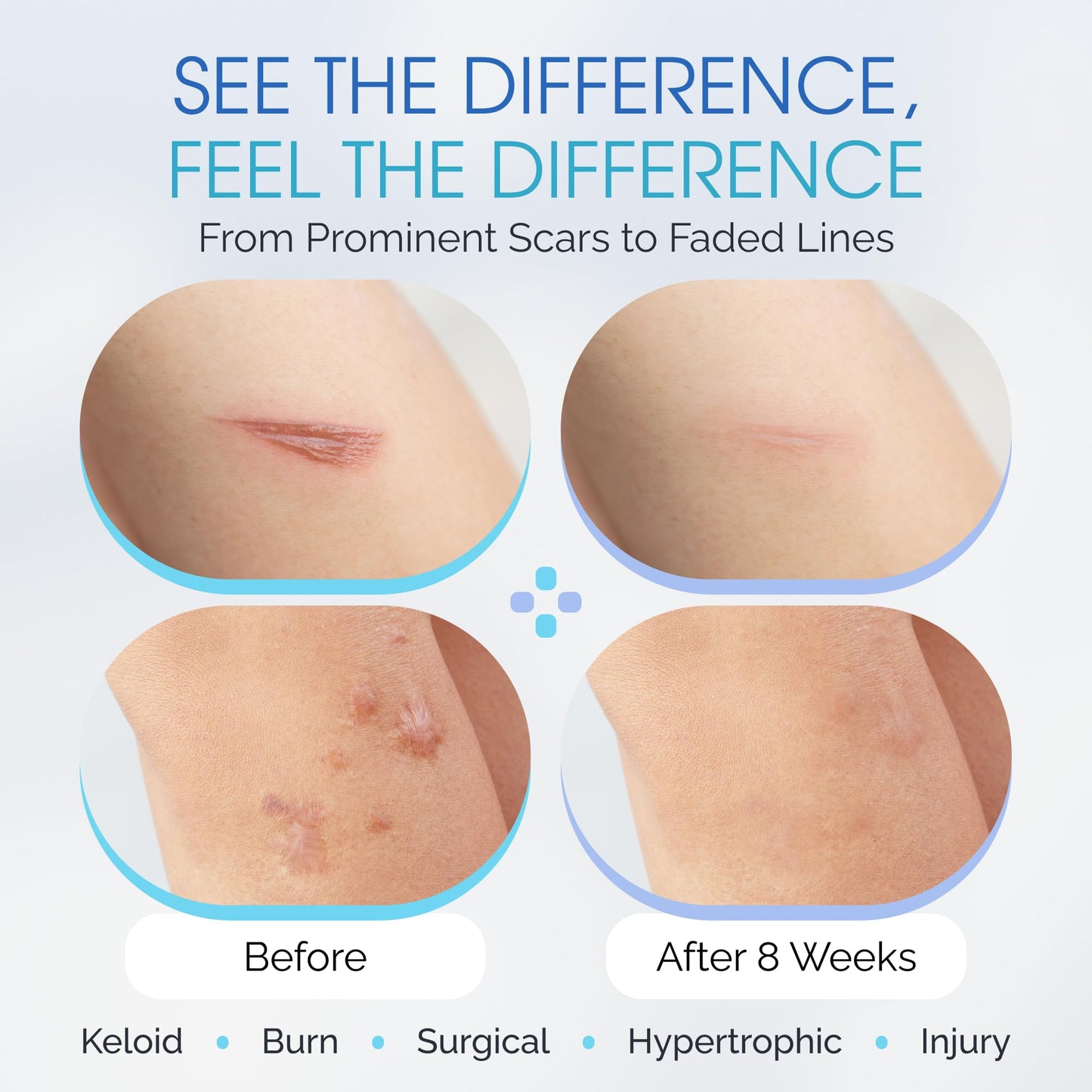 Advanced Medical Grade Silicone Scar Patches, 12 Reusable 3" Water-Resistant Silicone Scar Strips for Newly Healed Wounds and Older Scars - Breathable Silicone Gel Sheets for Scars w/Case