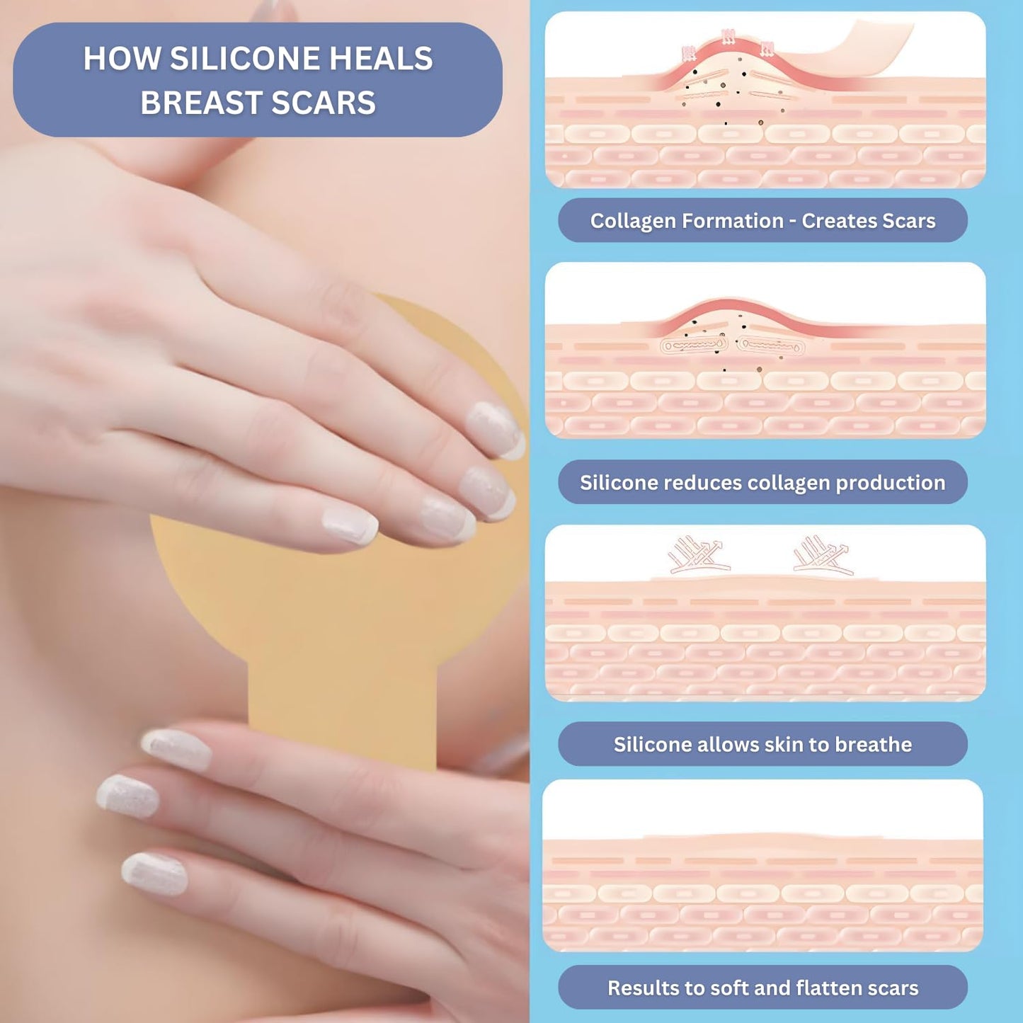 Silicone Scar Sheets for Breast Lift Mastopexy – Medical Grade Reusable Breast Surgery Scar Sheets – Soft Flexible and Comfortable Under Post-Op Bra