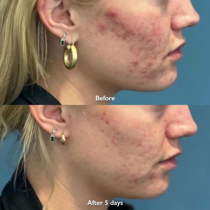 Orbe It! 2-Step Acne Treatment - Salicylic Acid Spray & Cream for Face & Body | Unclogs Pores, Reduces Pimples & Back Acne